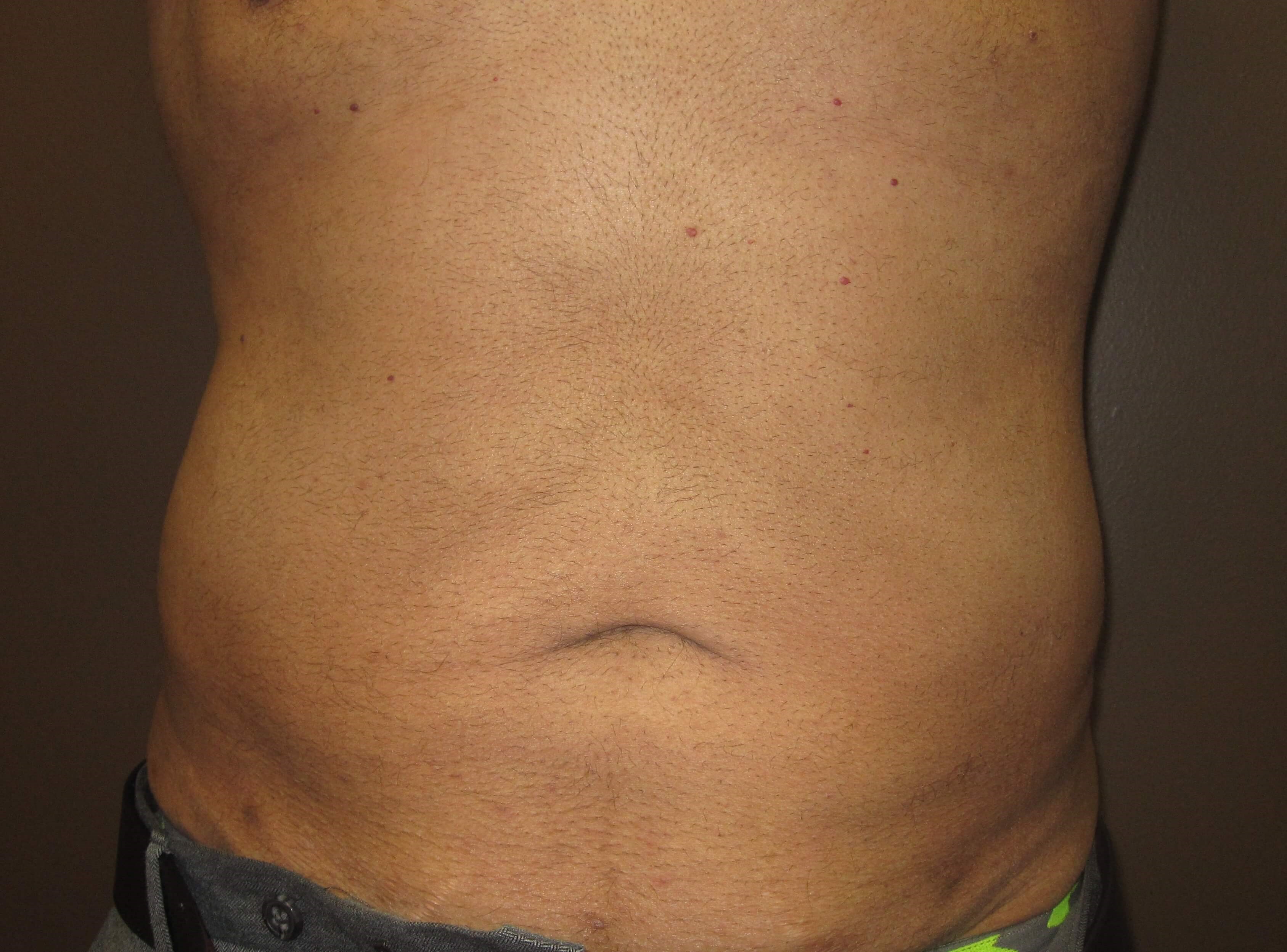 Liposuction After