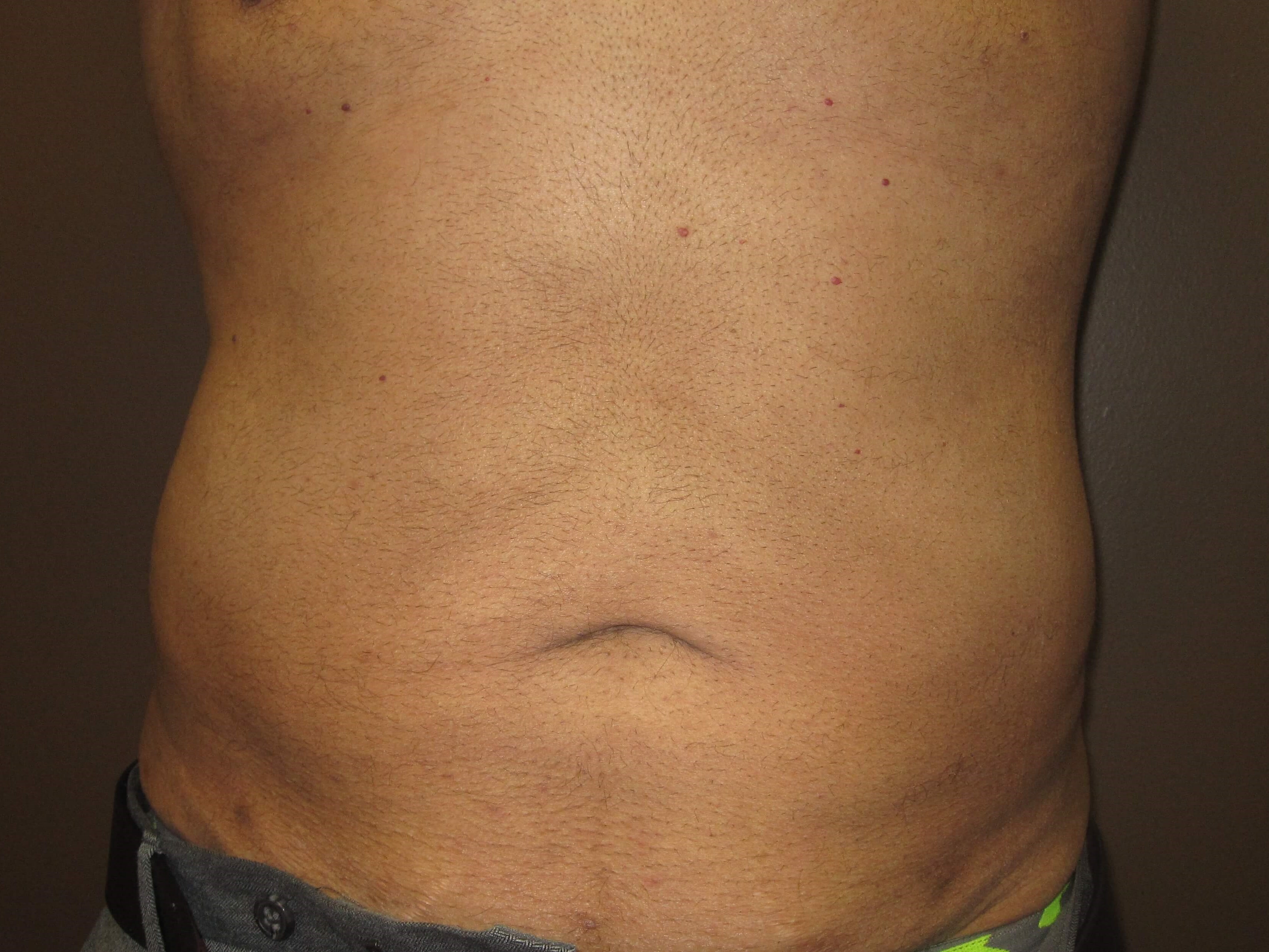 Liposuction After