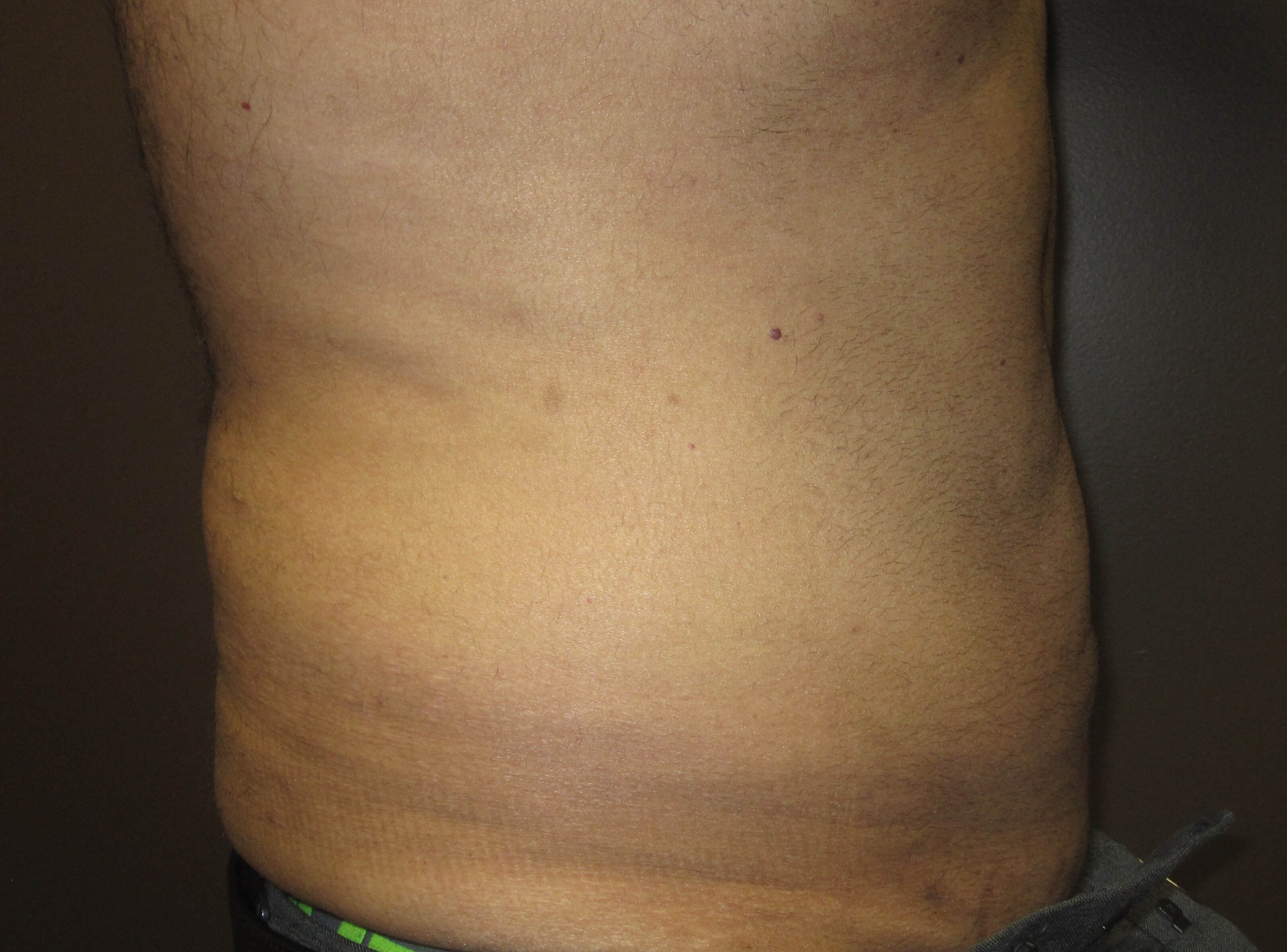 Liposuction After