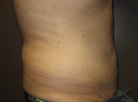Liposuction After
