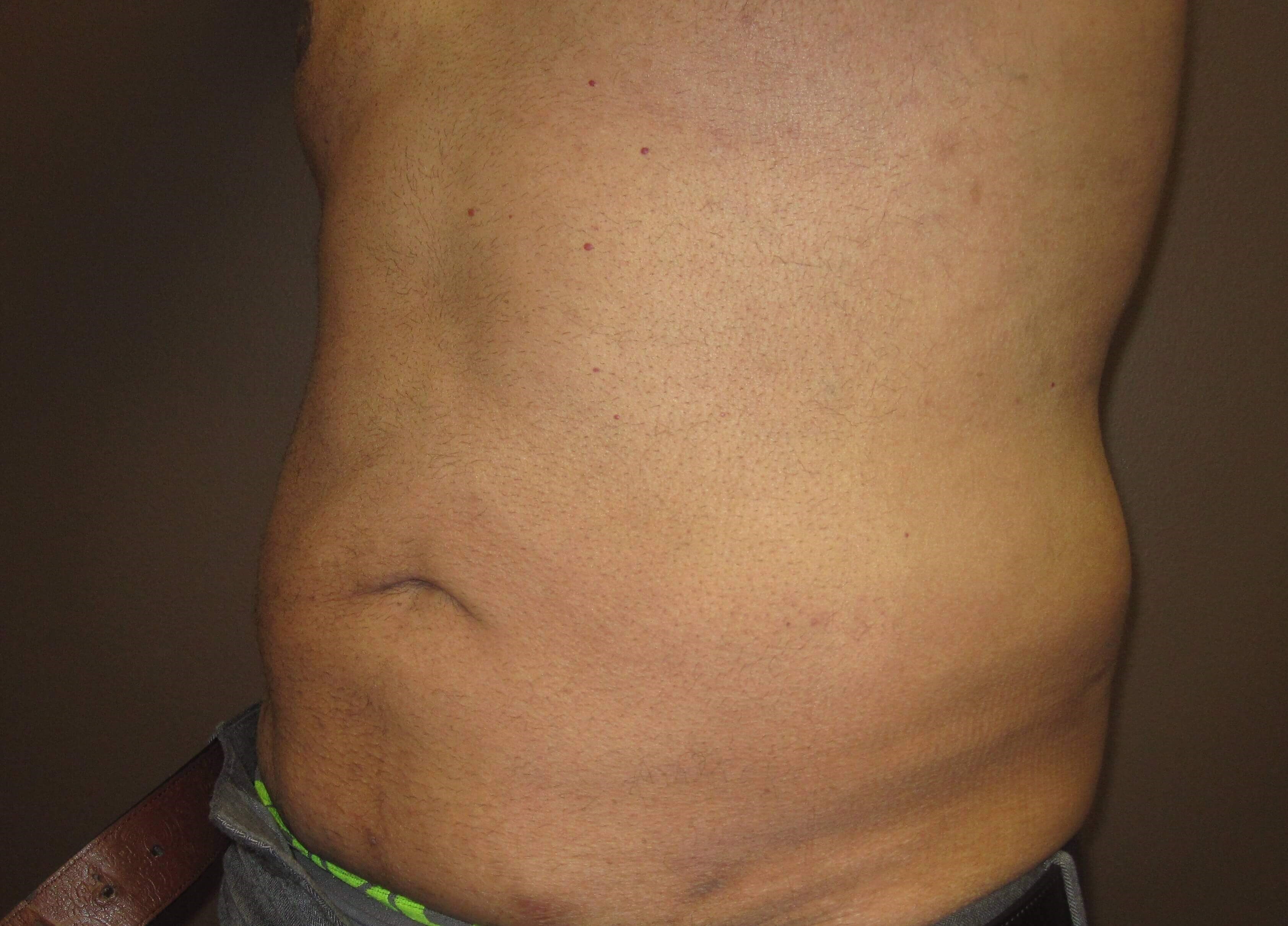 Liposuction After