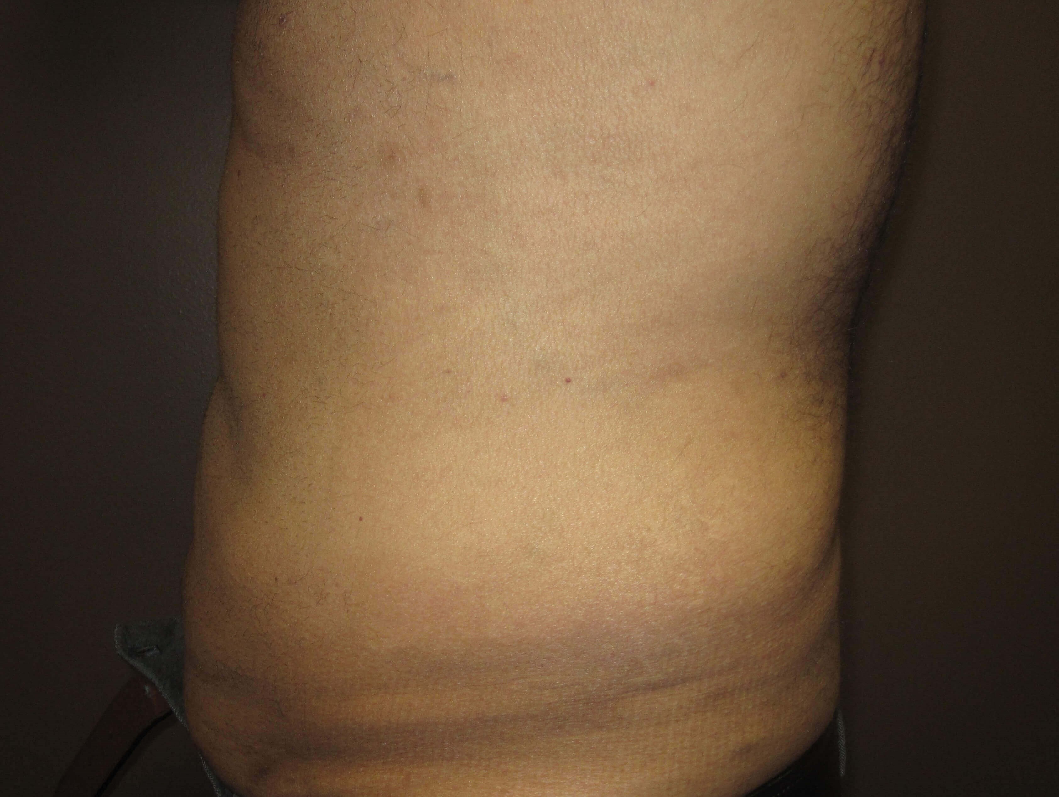 Liposuction After
