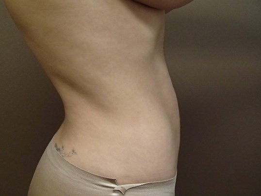 Liposuction After