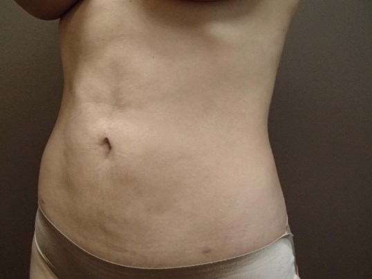 Liposuction After