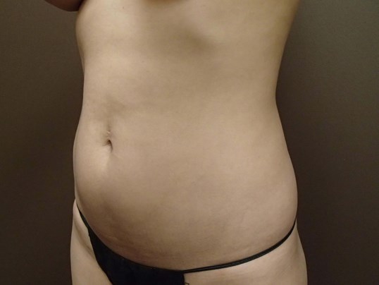 Liposuction Before