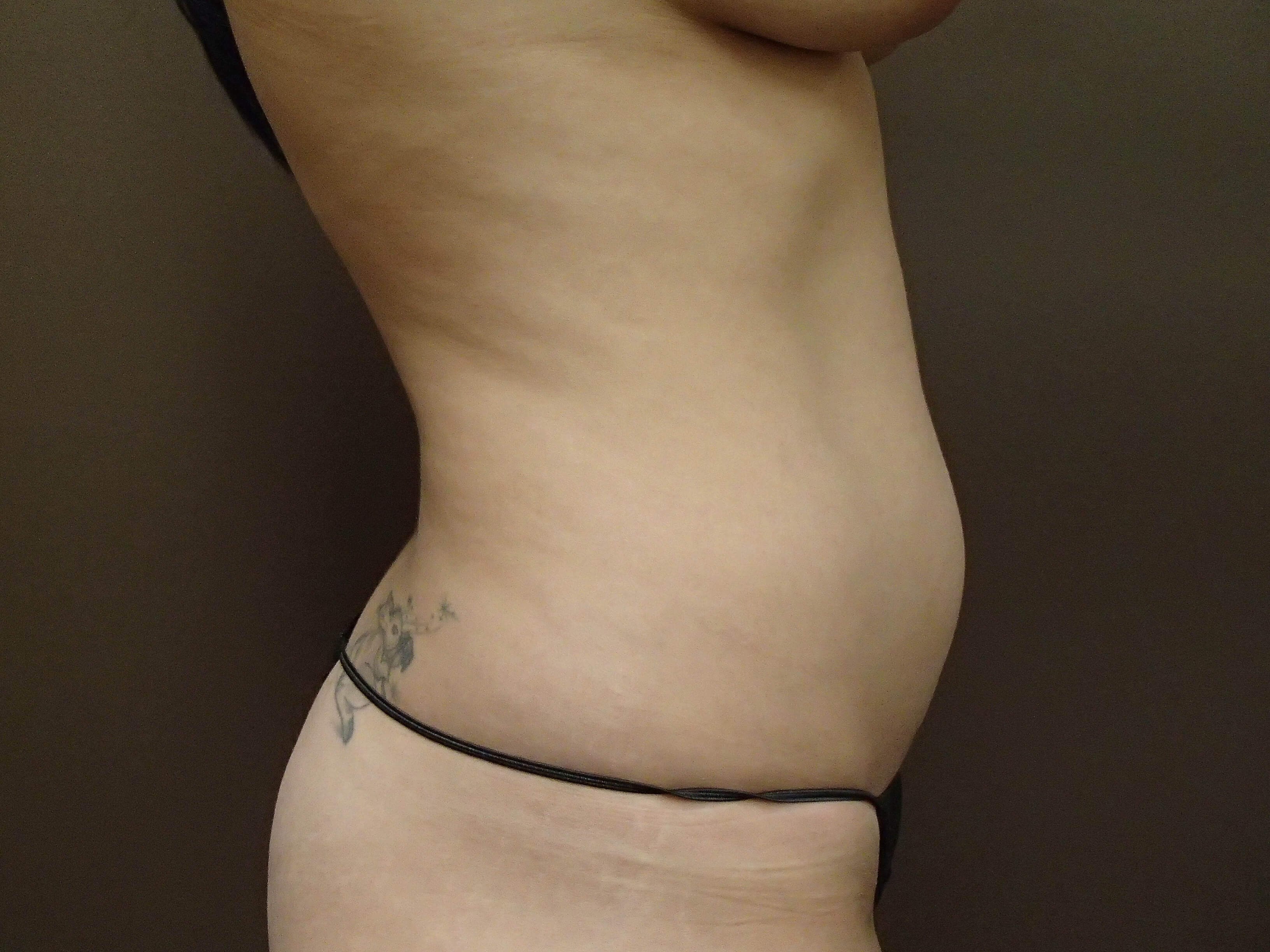 Liposuction Before