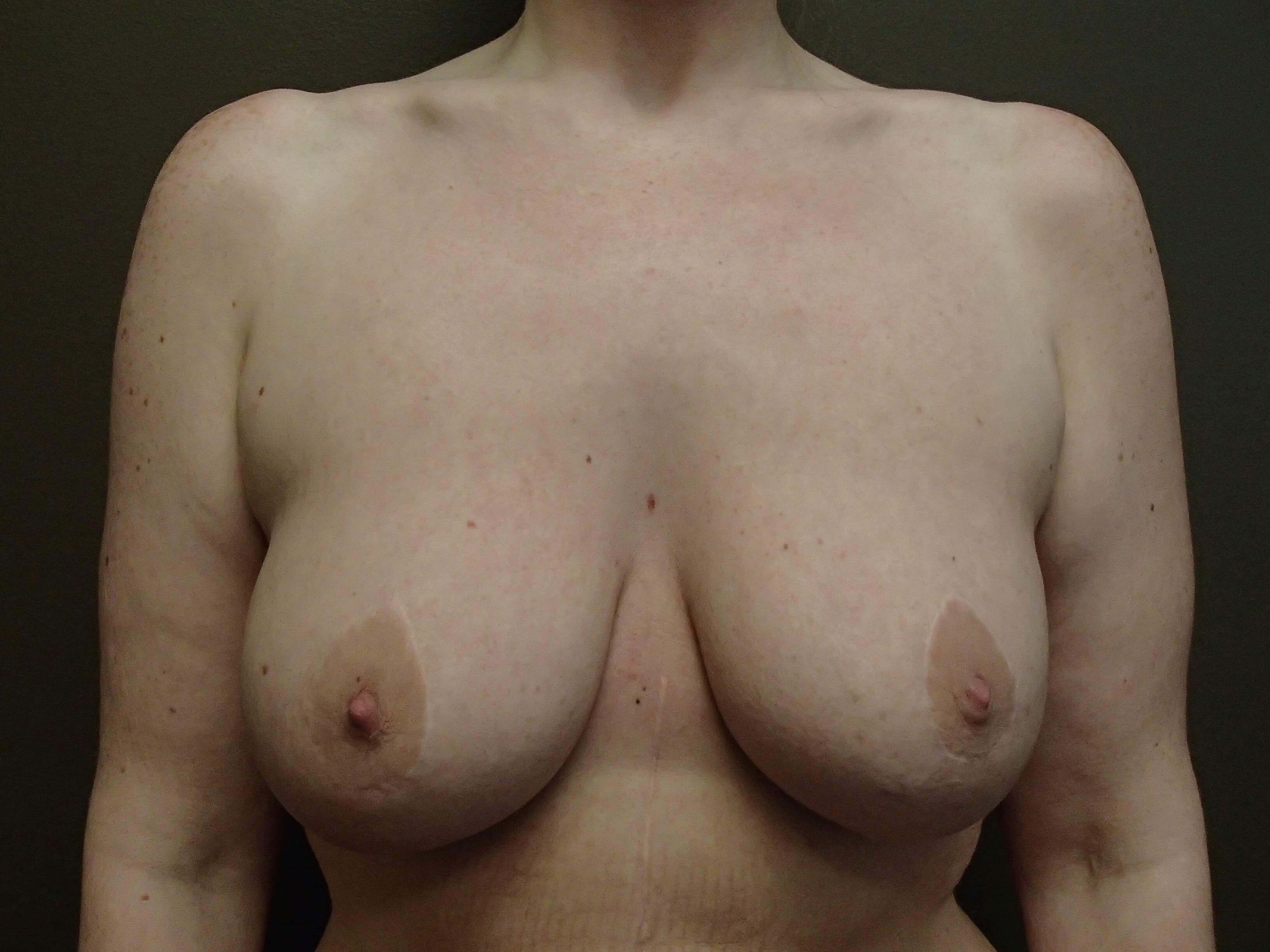 Breast Revision Before