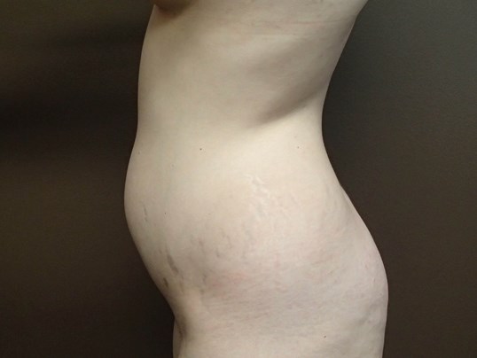 Liposuction Before
