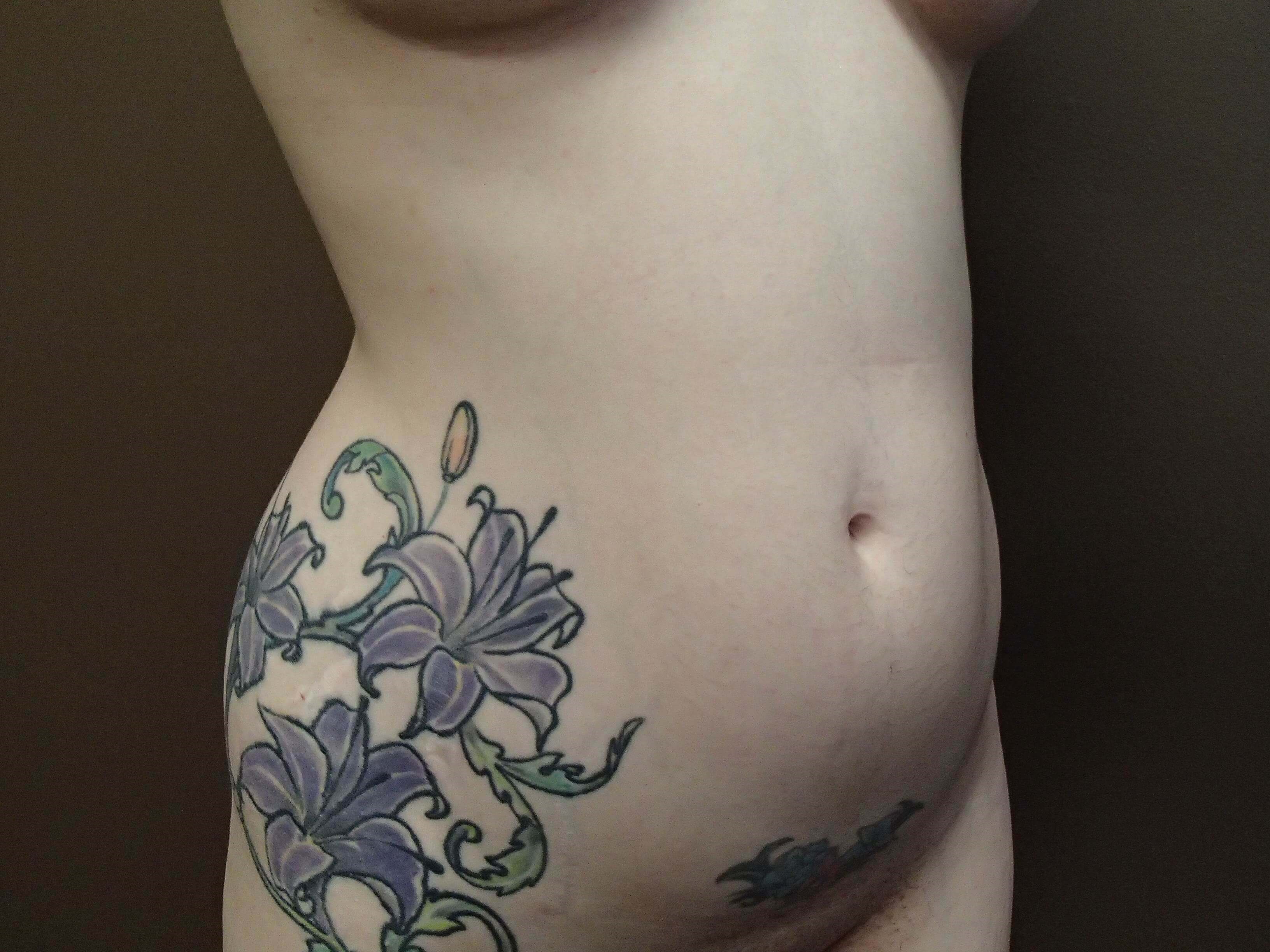Liposuction Before