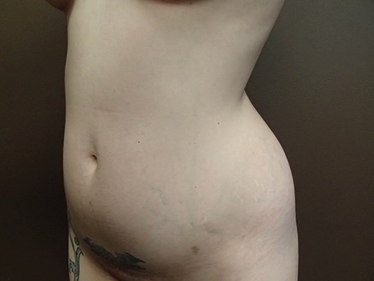Liposuction Before