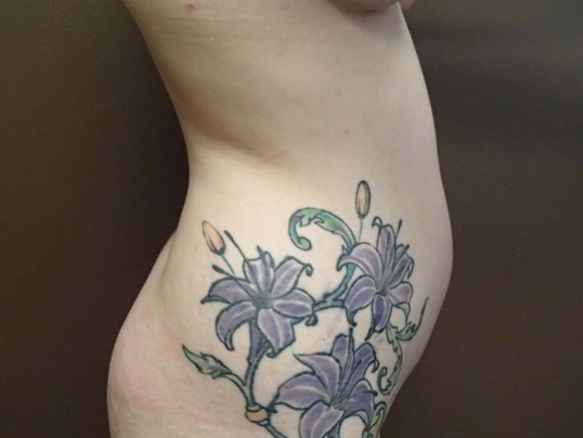 Liposuction Before