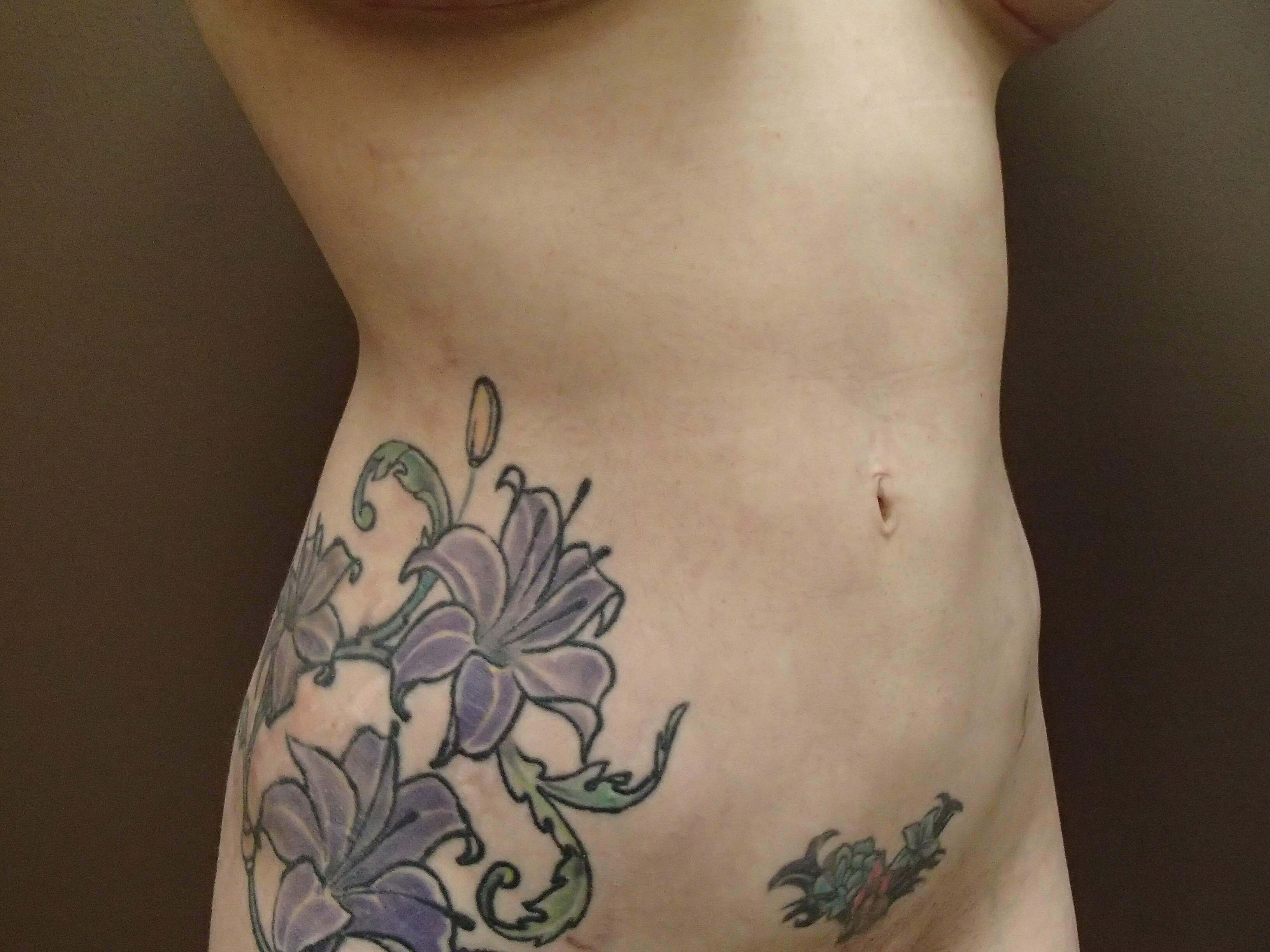 Liposuction After