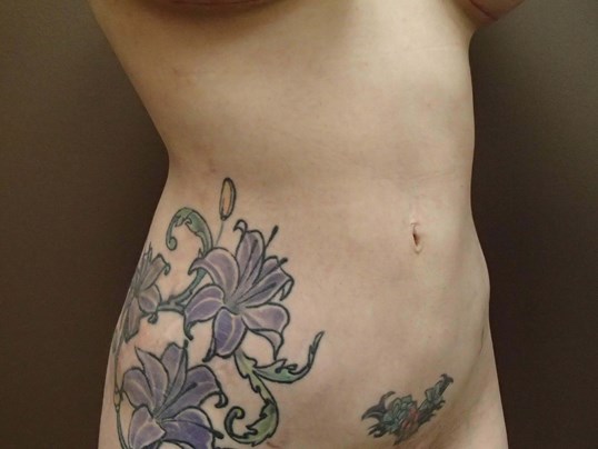 Liposuction After