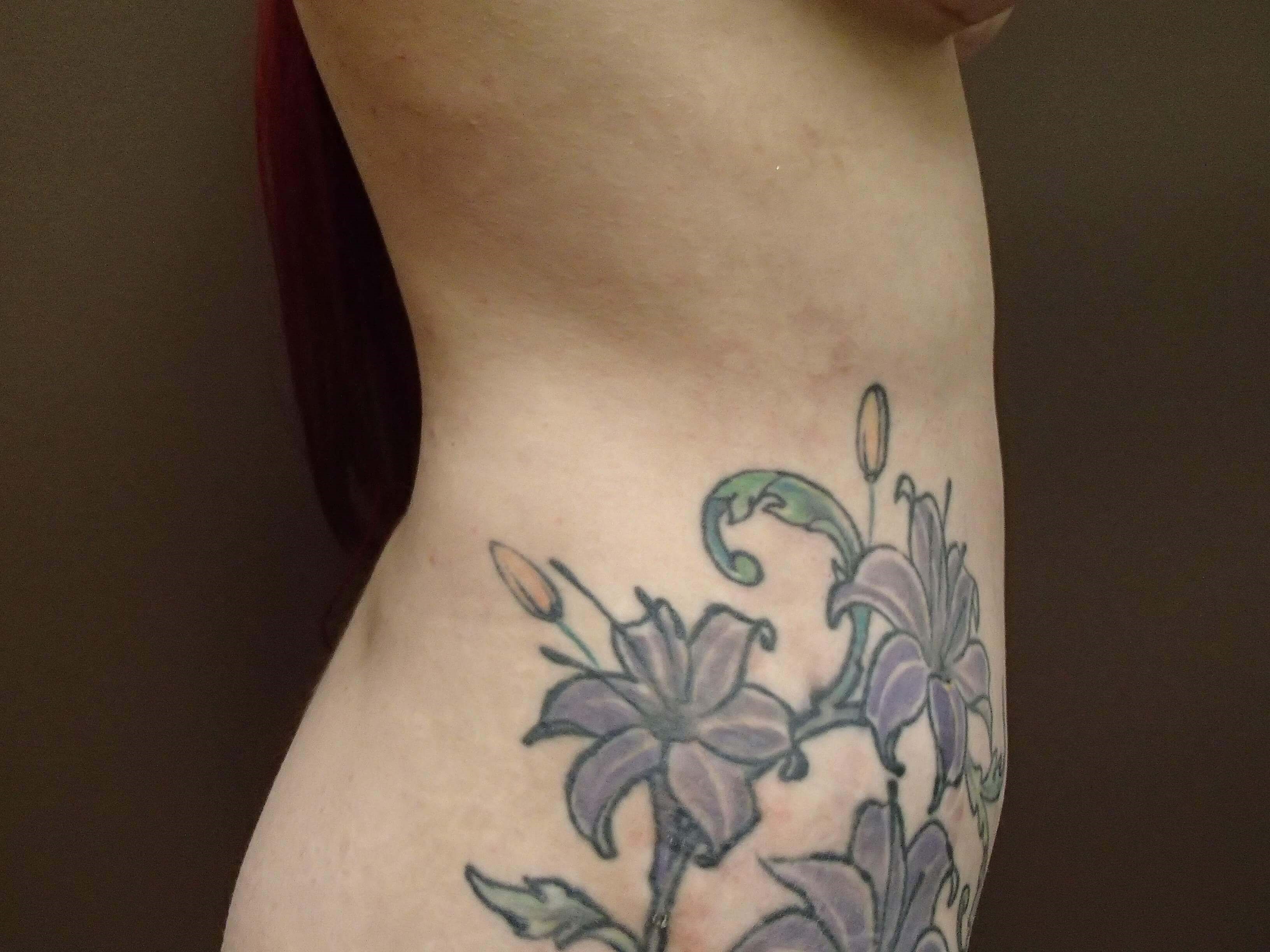 Liposuction After