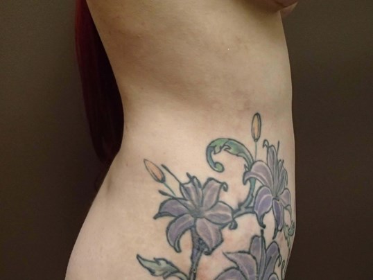 Liposuction After