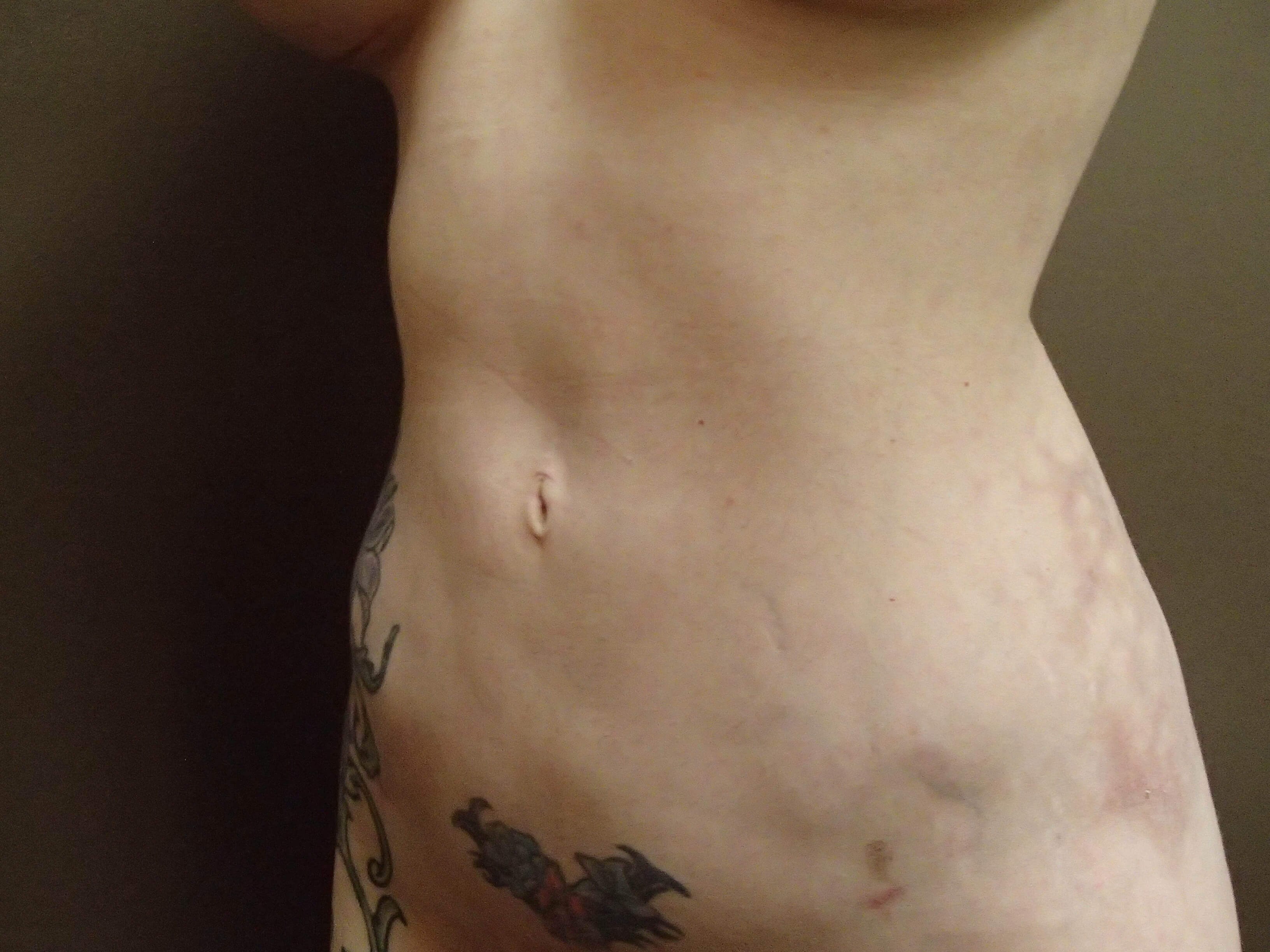 Liposuction After