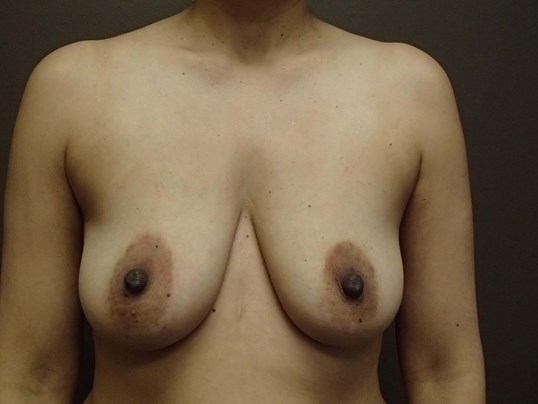 Mastopexy (Breast Lift) Before