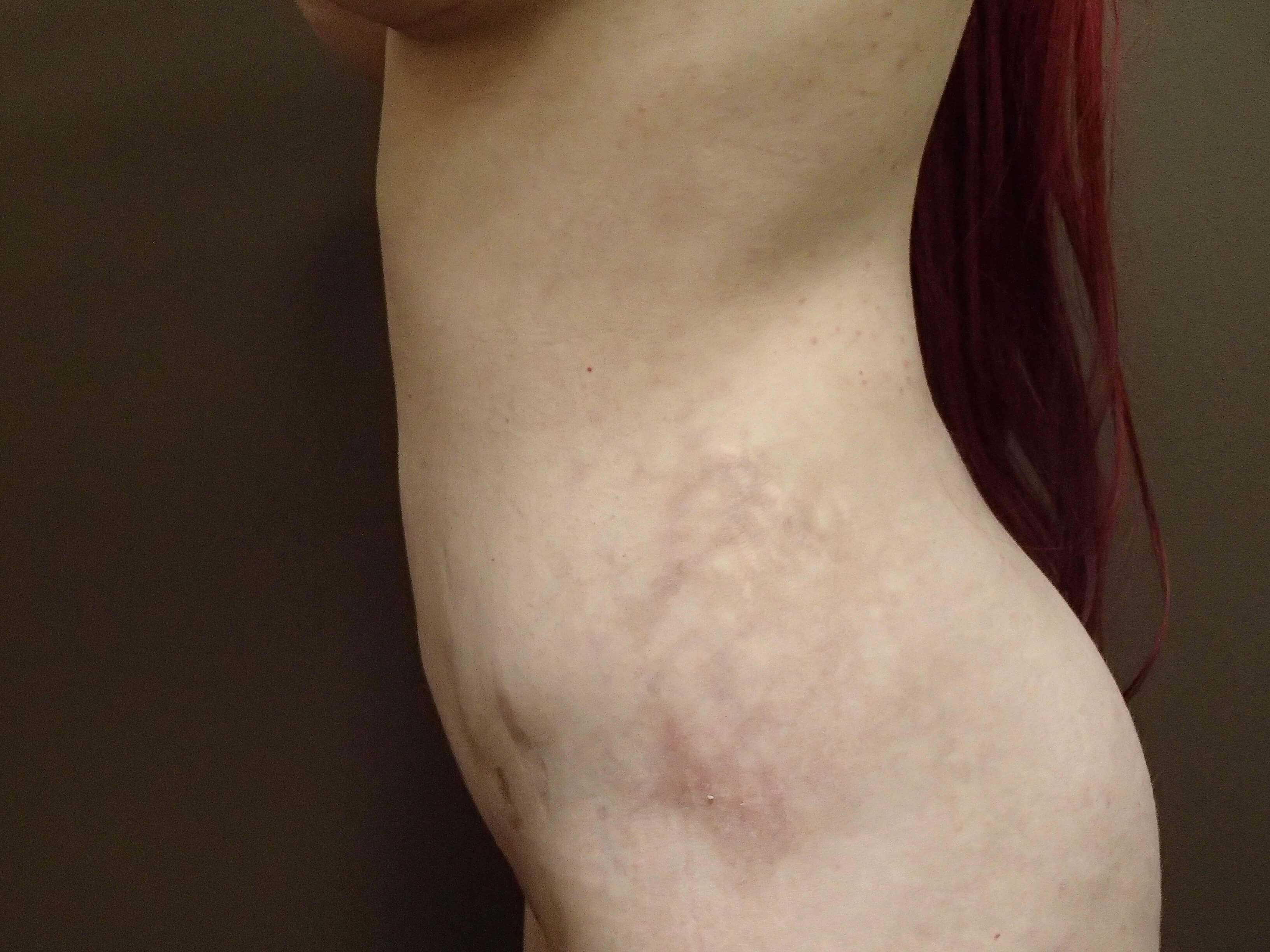 Liposuction After