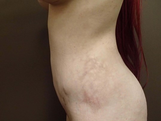 Liposuction After
