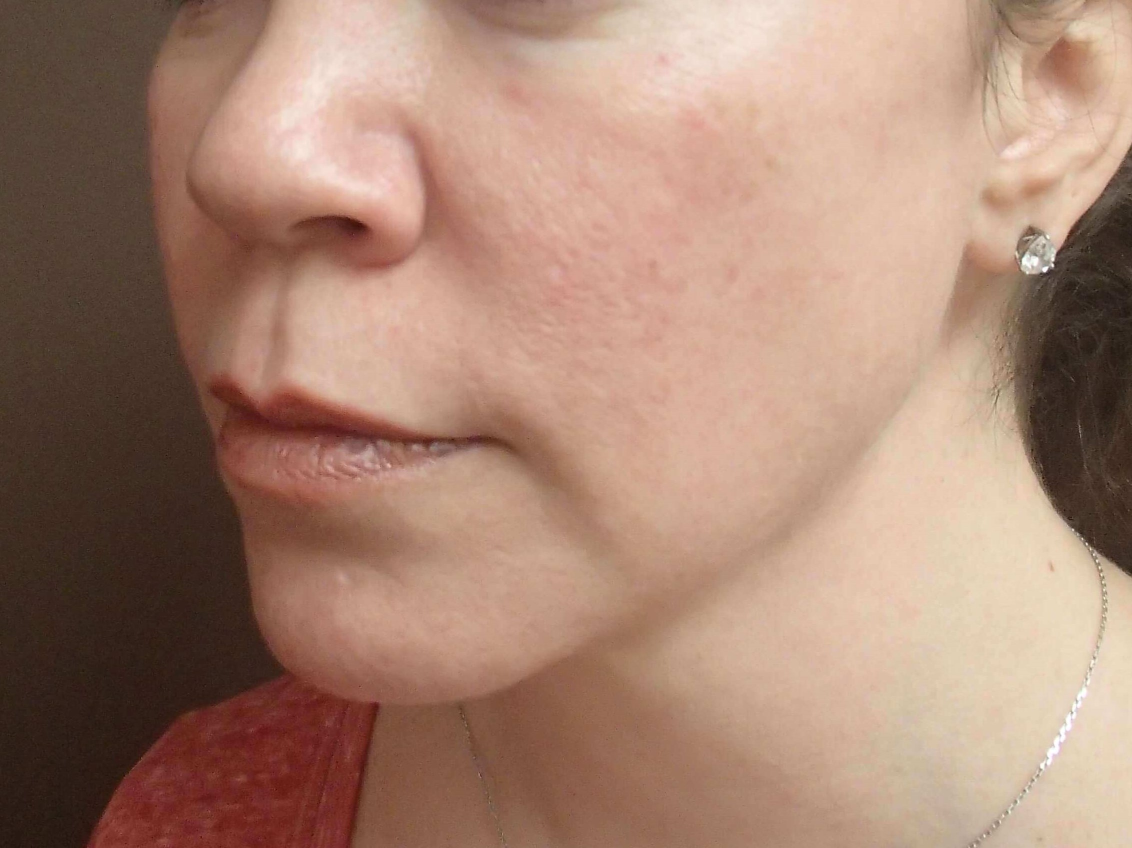 Ultherapy Full Face and Neck After
