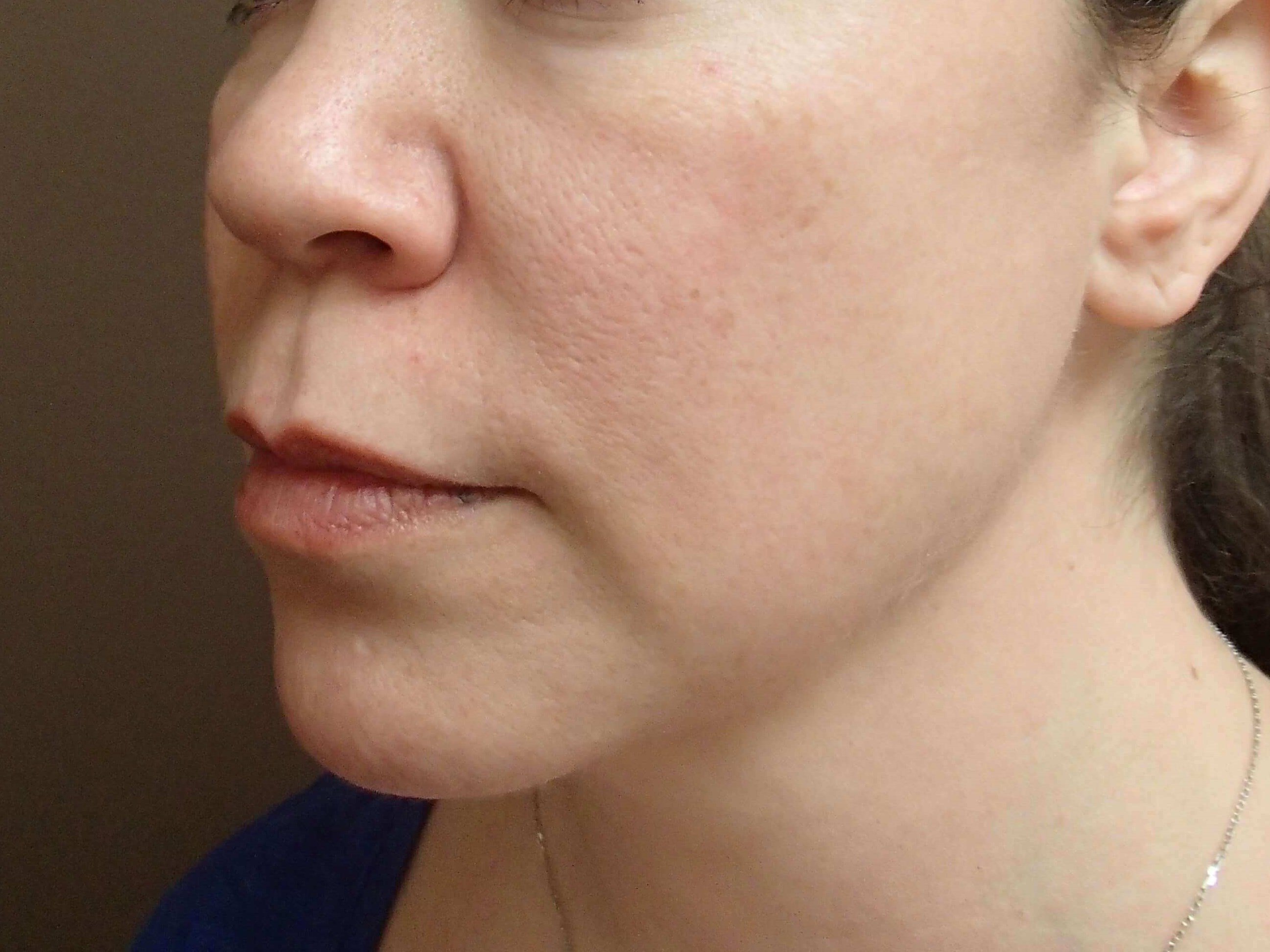Ultherapy Full Face and Neck Before