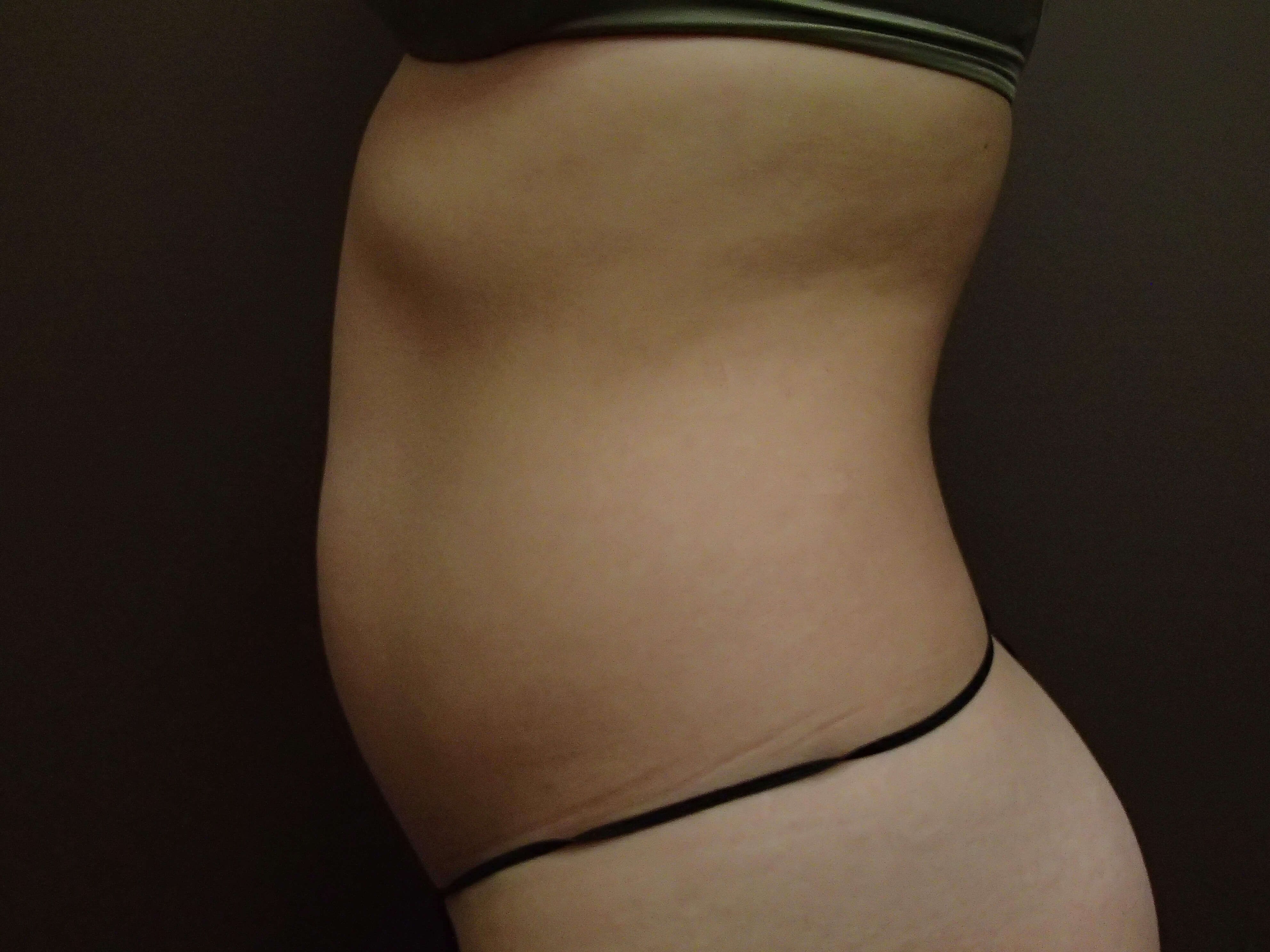 Liposuction Before