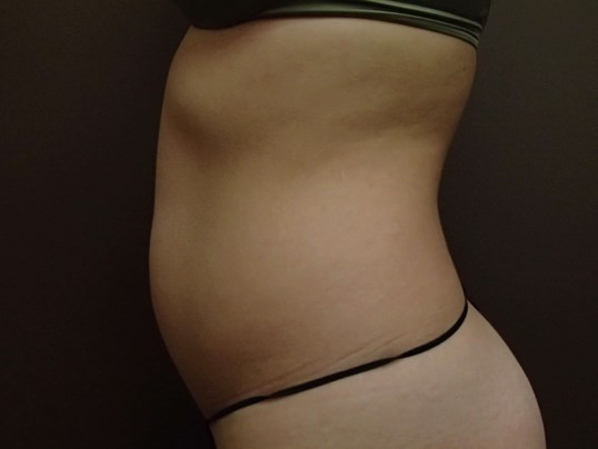 Liposuction Before