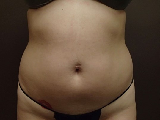Liposuction Before