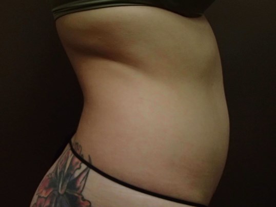 Liposuction Before
