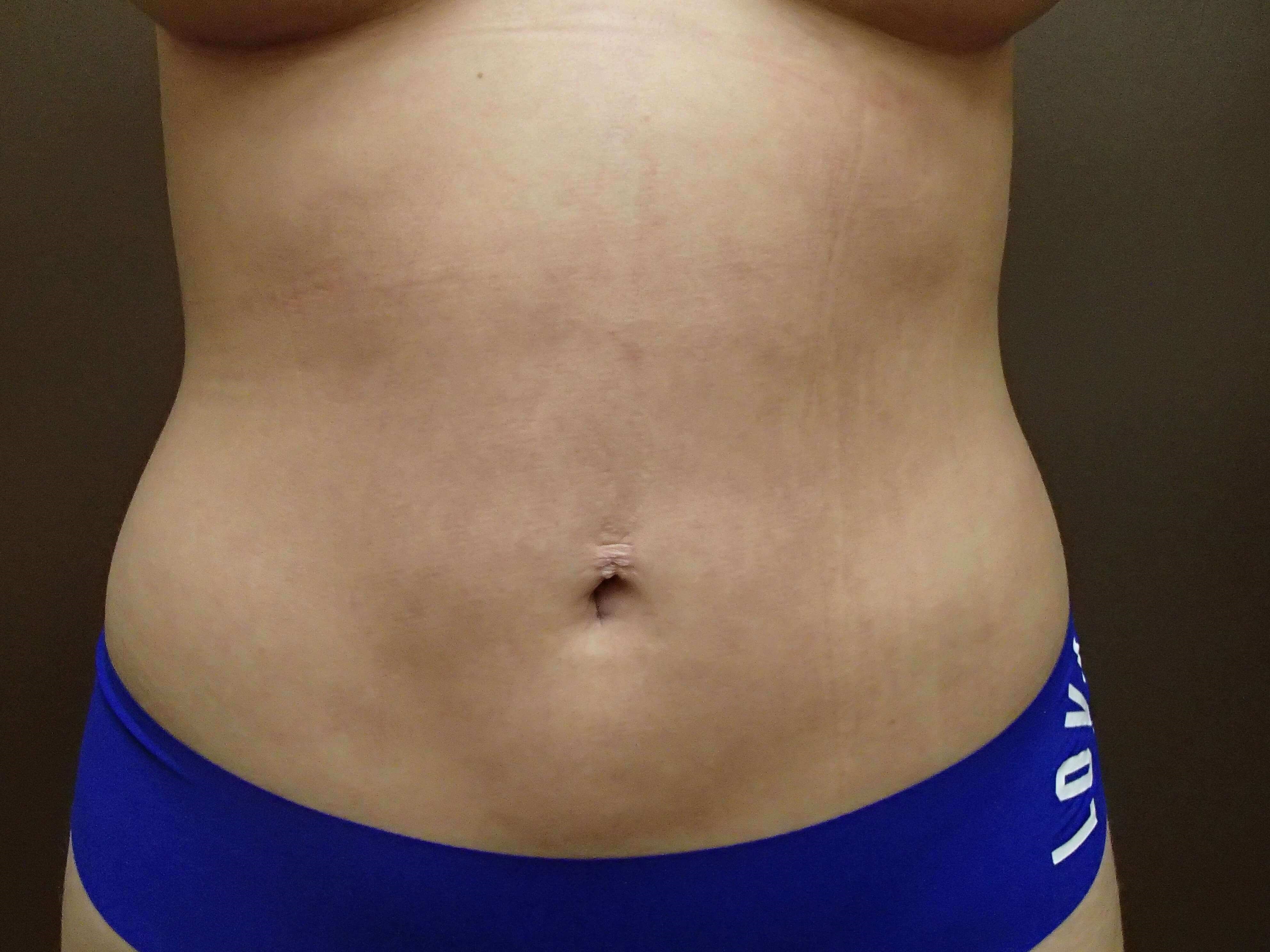 Liposuction After