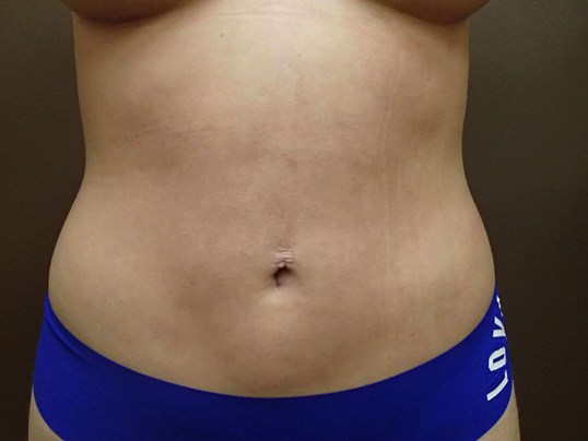 Liposuction After