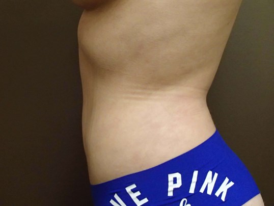 Liposuction After