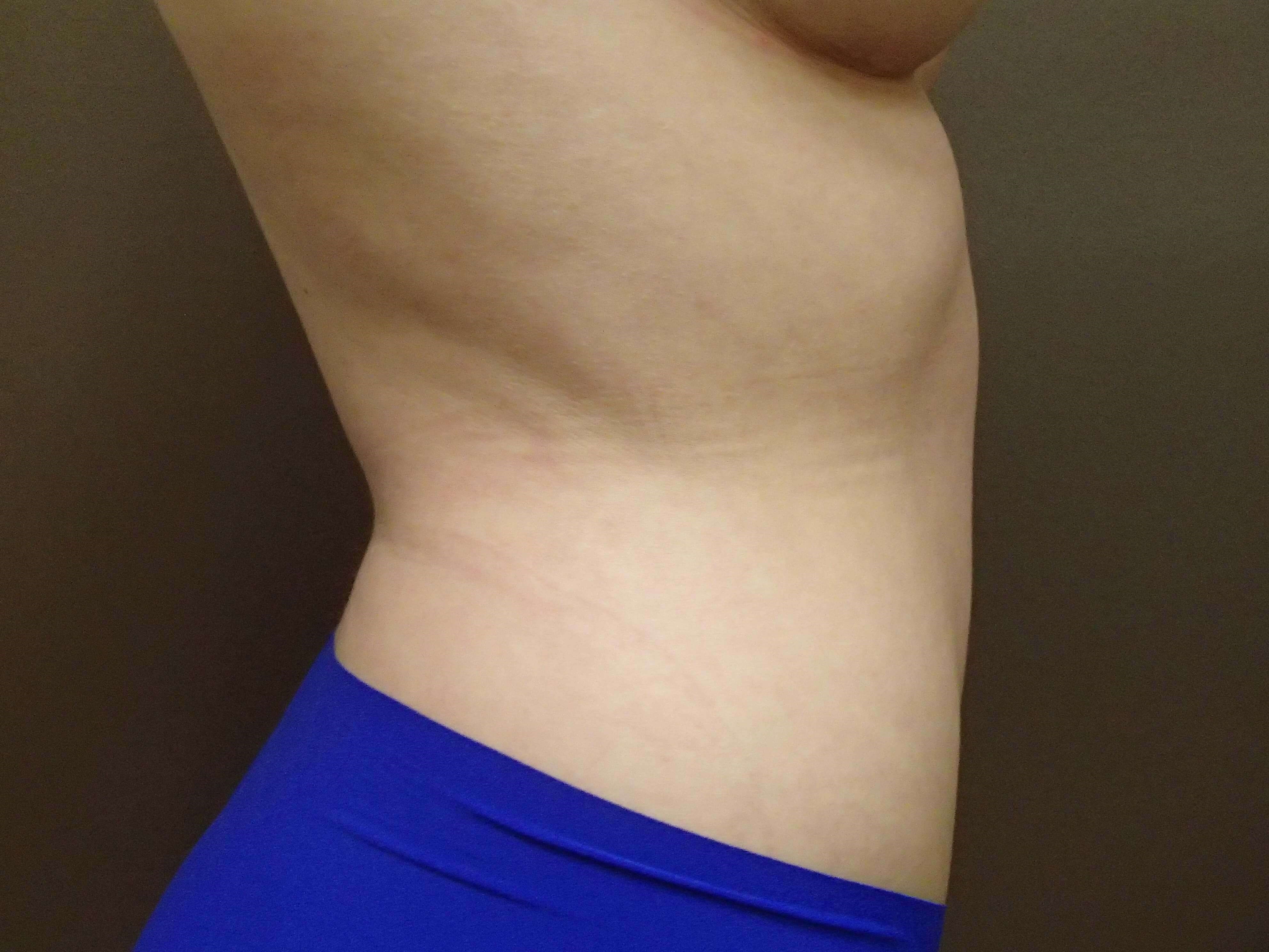 Liposuction After