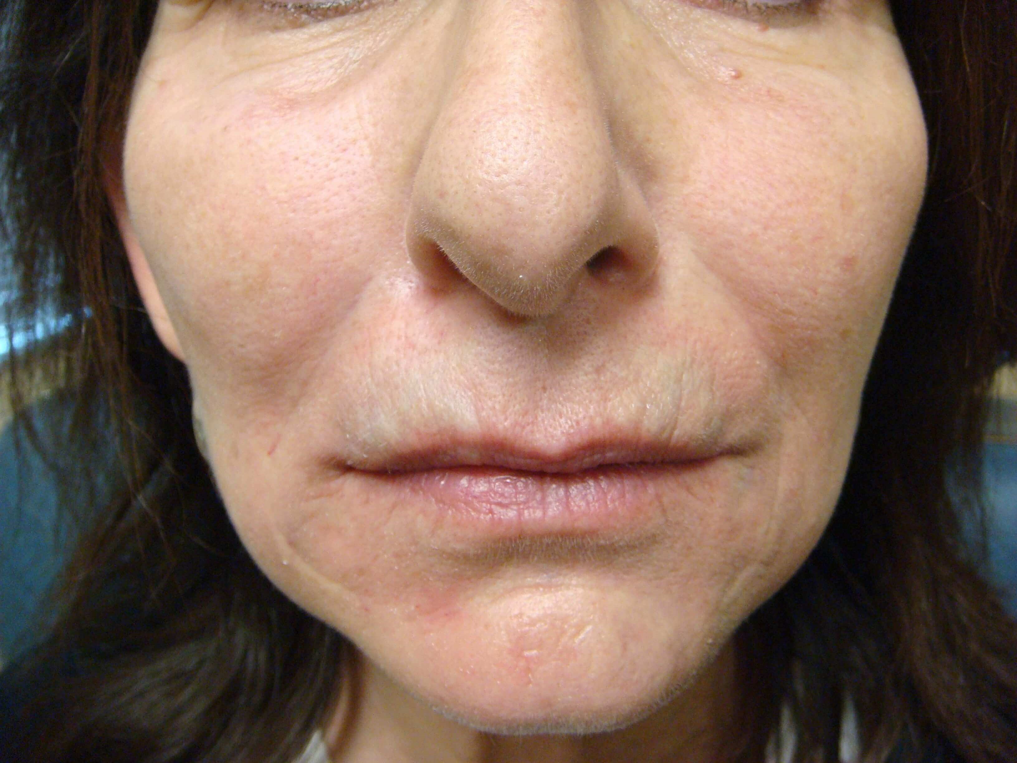 Radiesse After