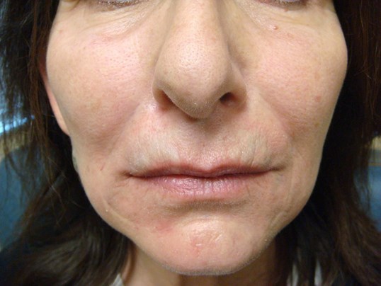 Radiesse After