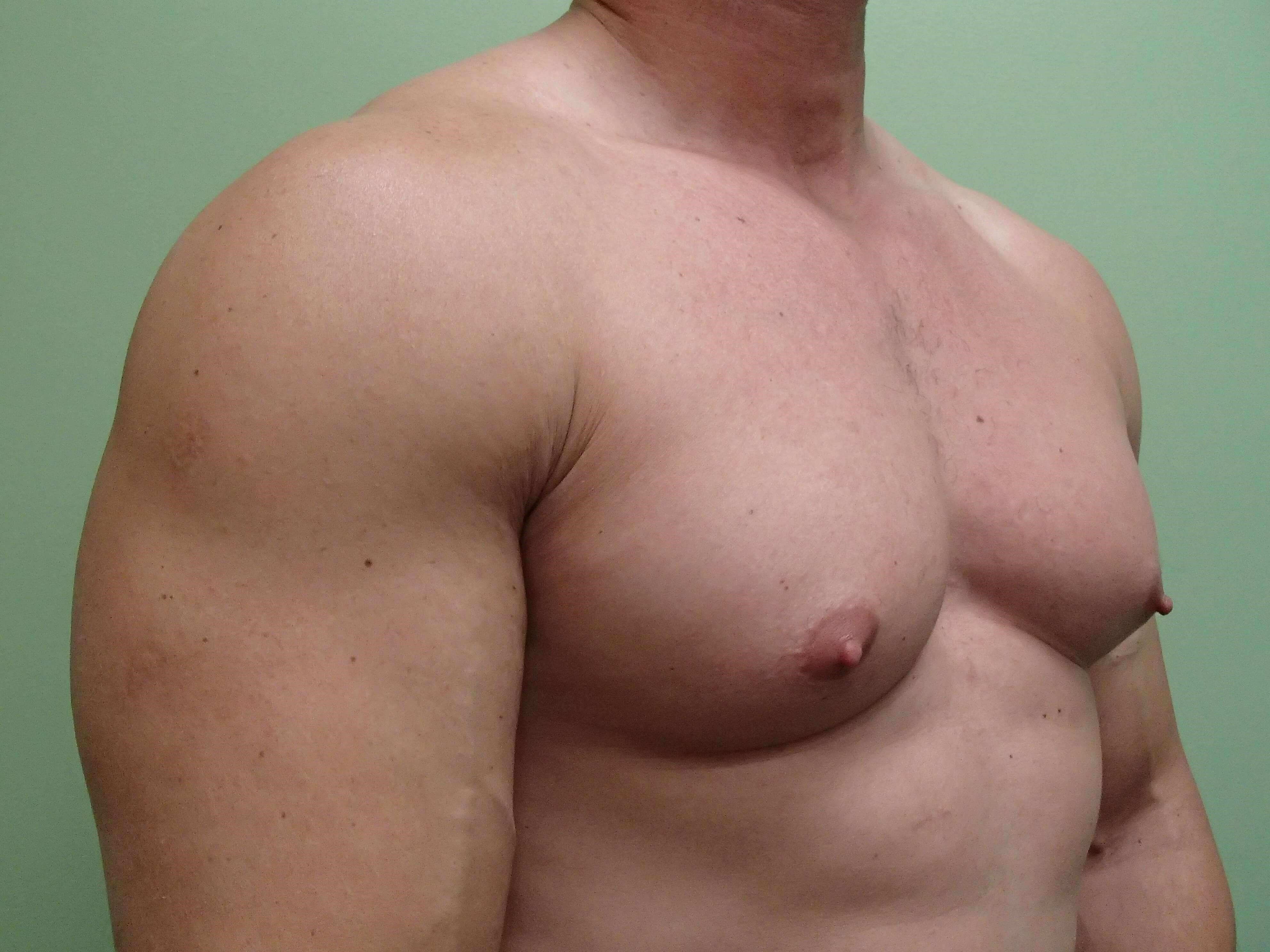Gynecomastia (male breast redu Before