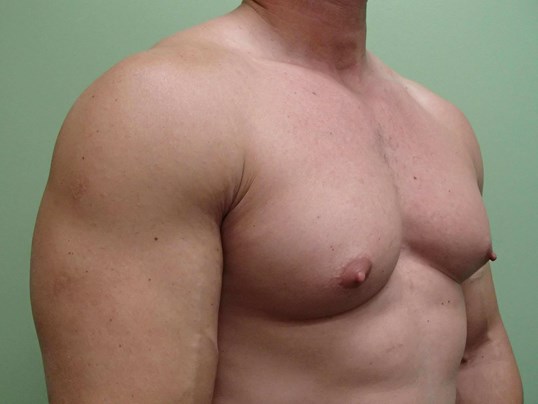 Gynecomastia (male breast redu Before