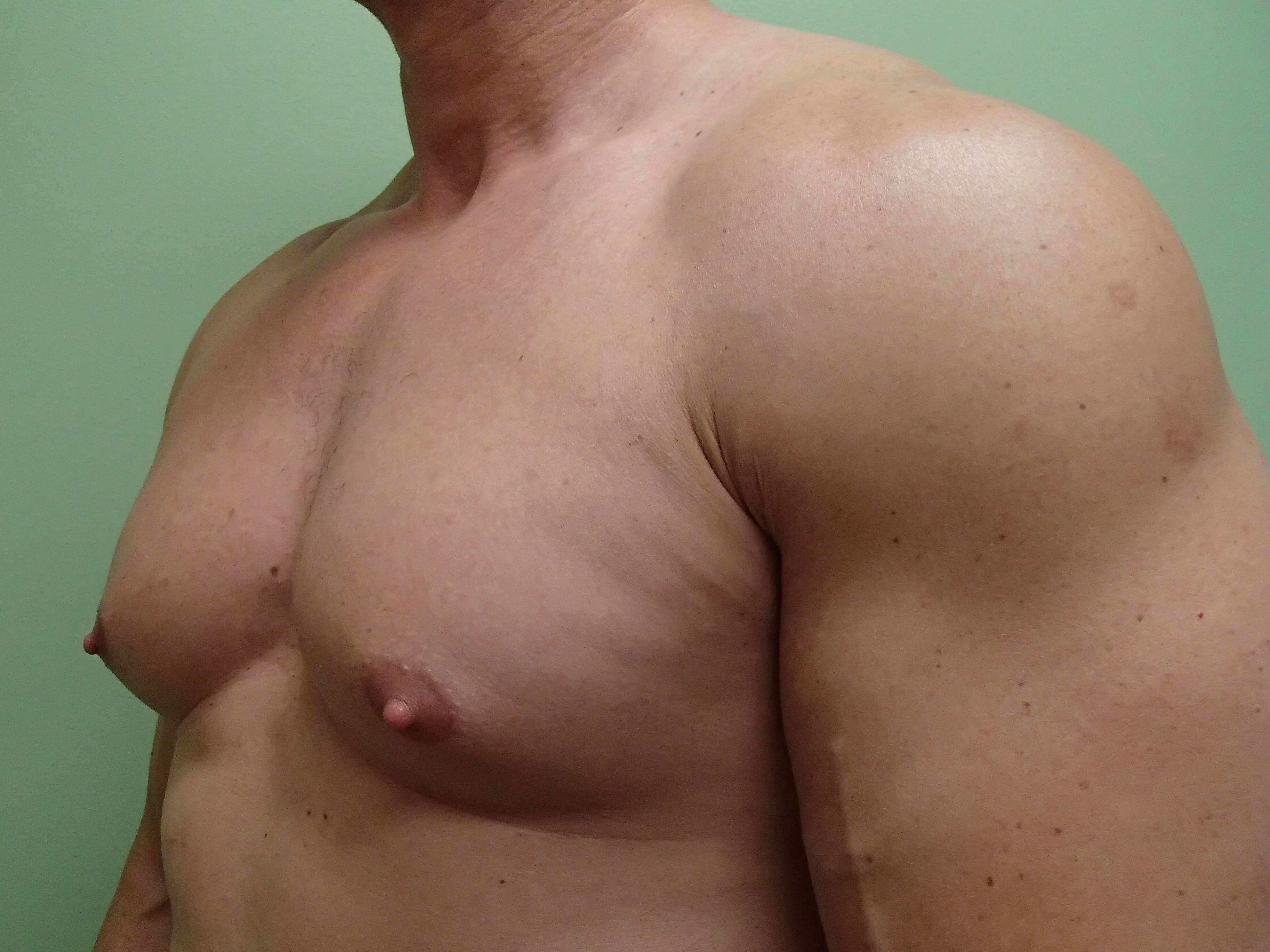 Gynecomastia (male breast redu Before