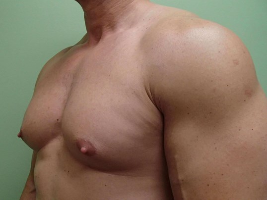 Gynecomastia (male breast redu Before