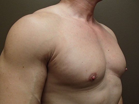 Gynecomastia (male breast redu After