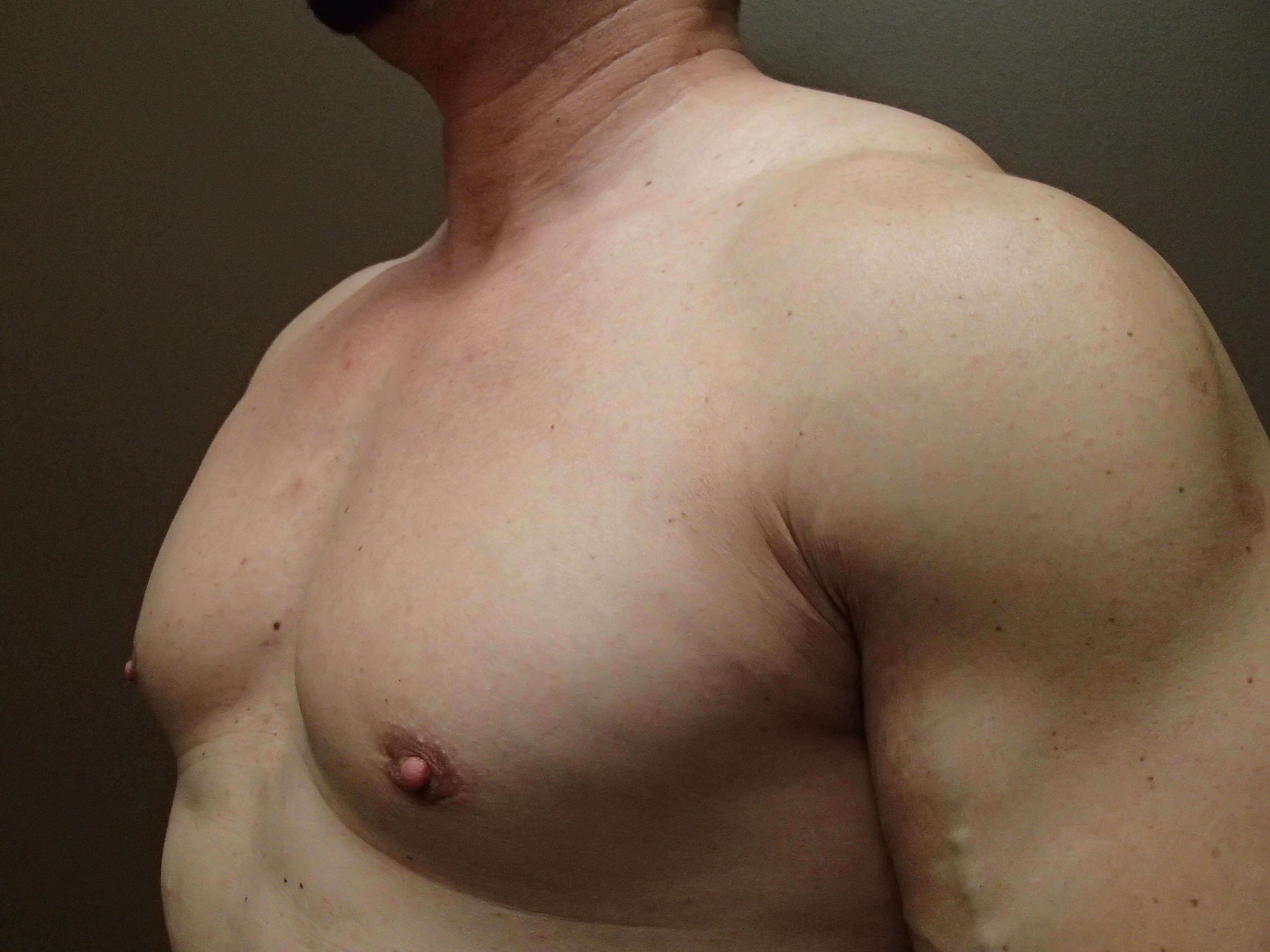 Gynecomastia (male breast redu After