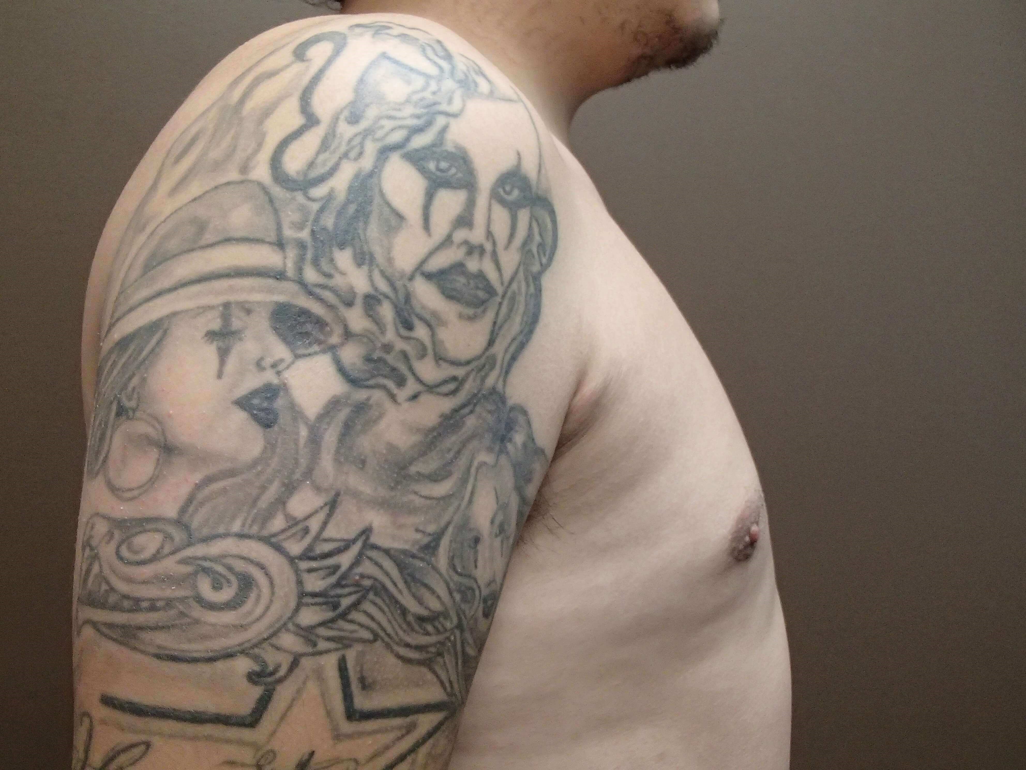 Gynecomastia (male breast redu After