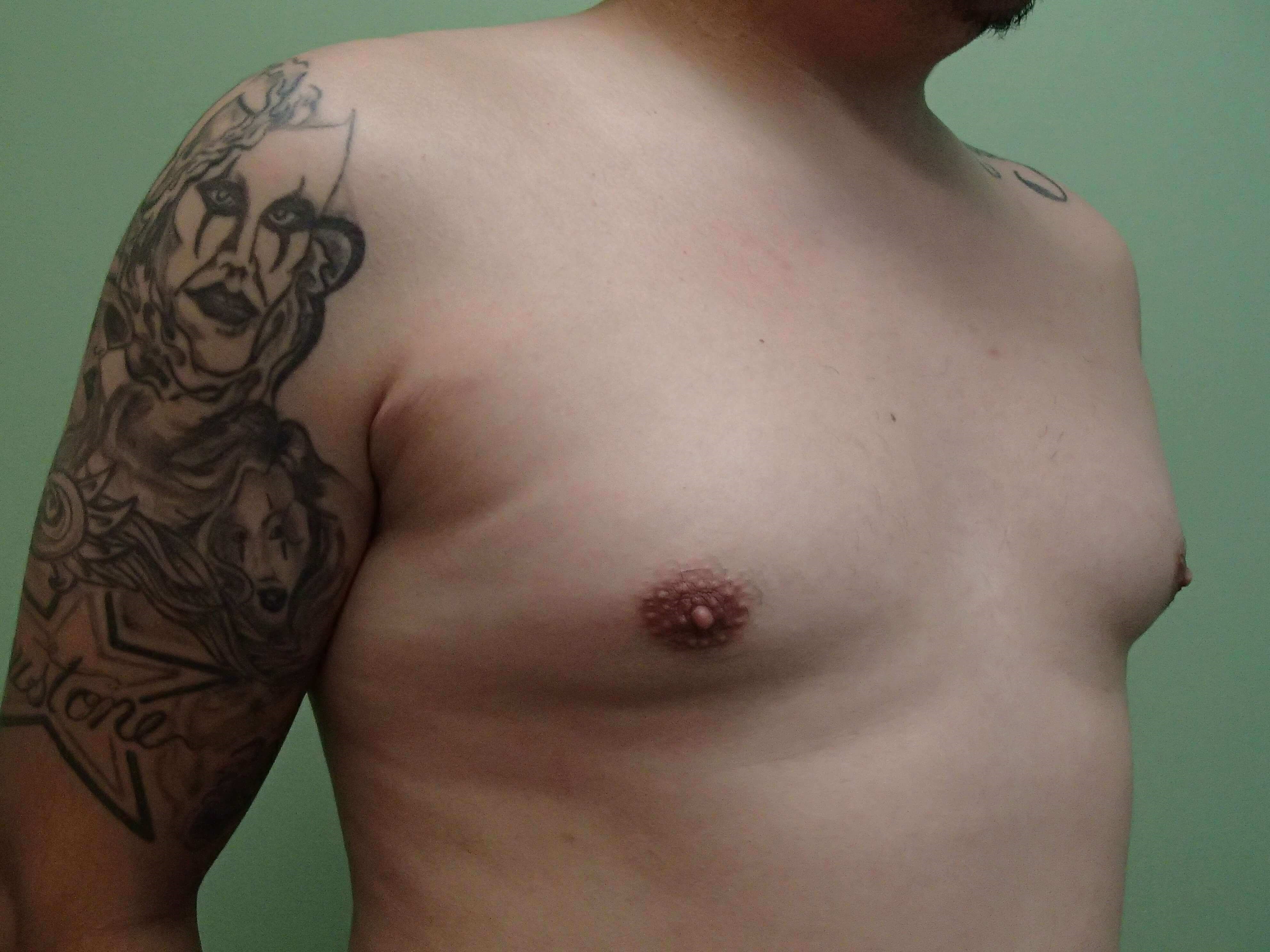 Gynecomastia (male breast redu Before