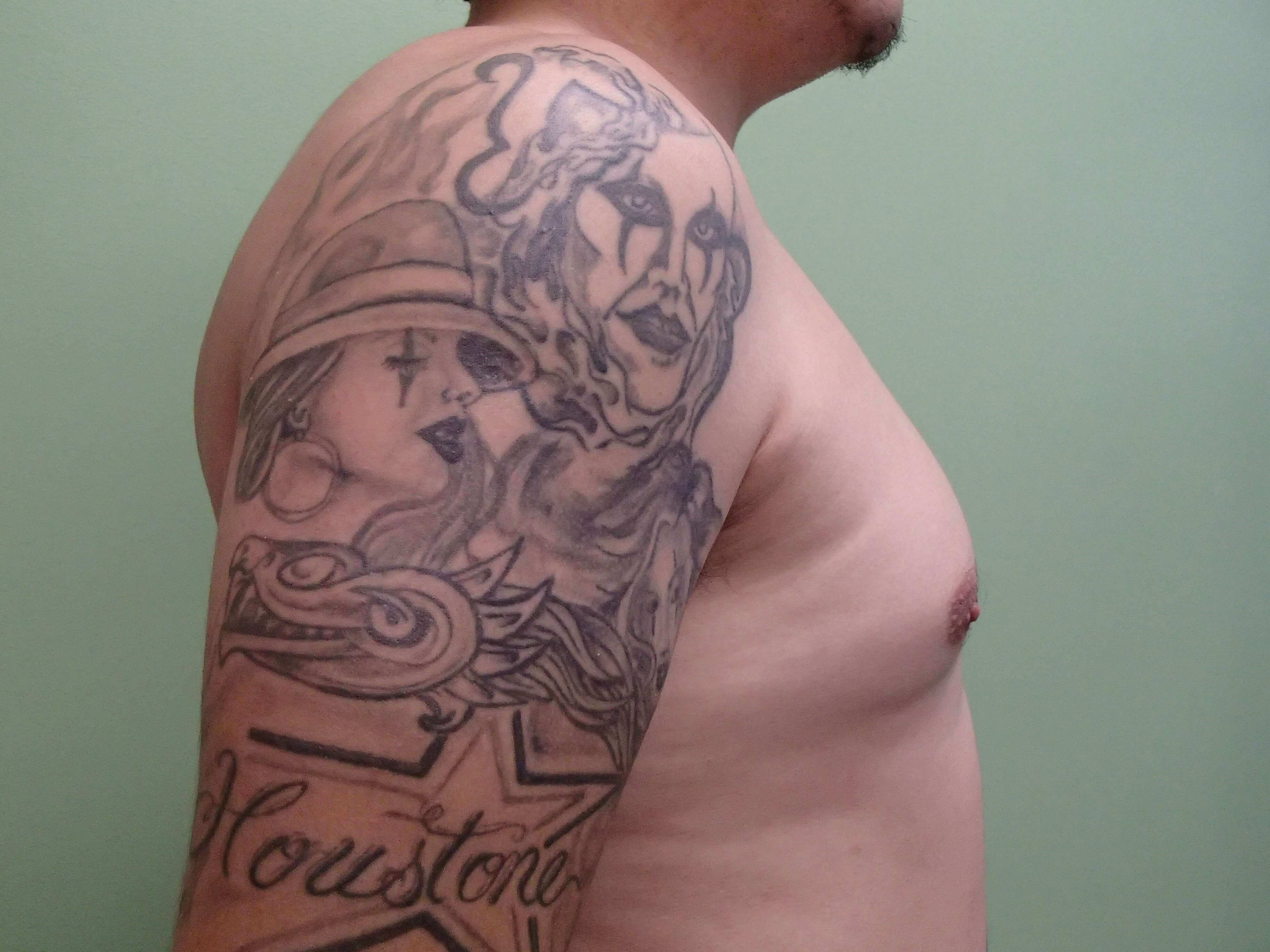Gynecomastia (male breast redu Before