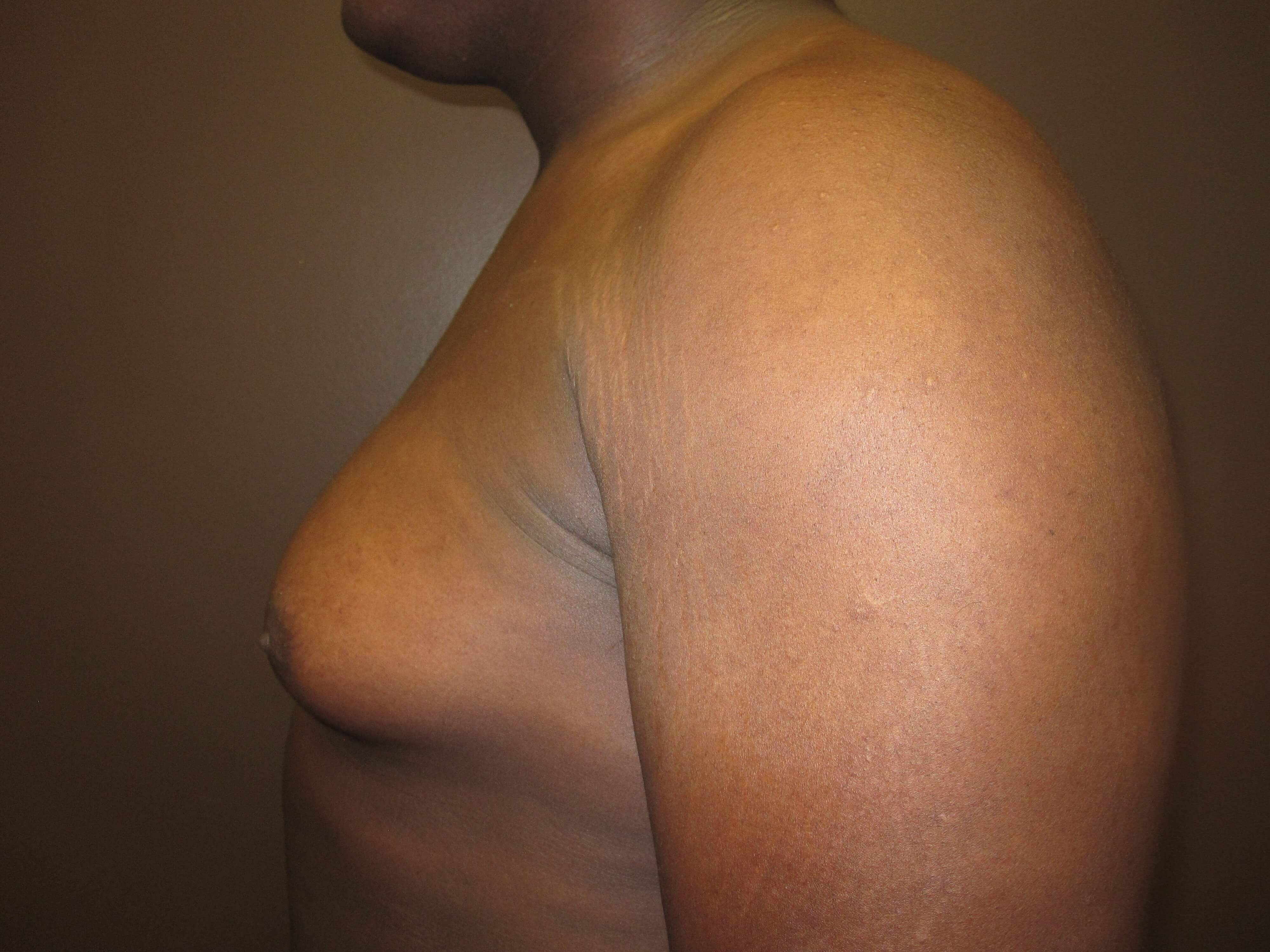 Gynecomastia (male breast redu Before