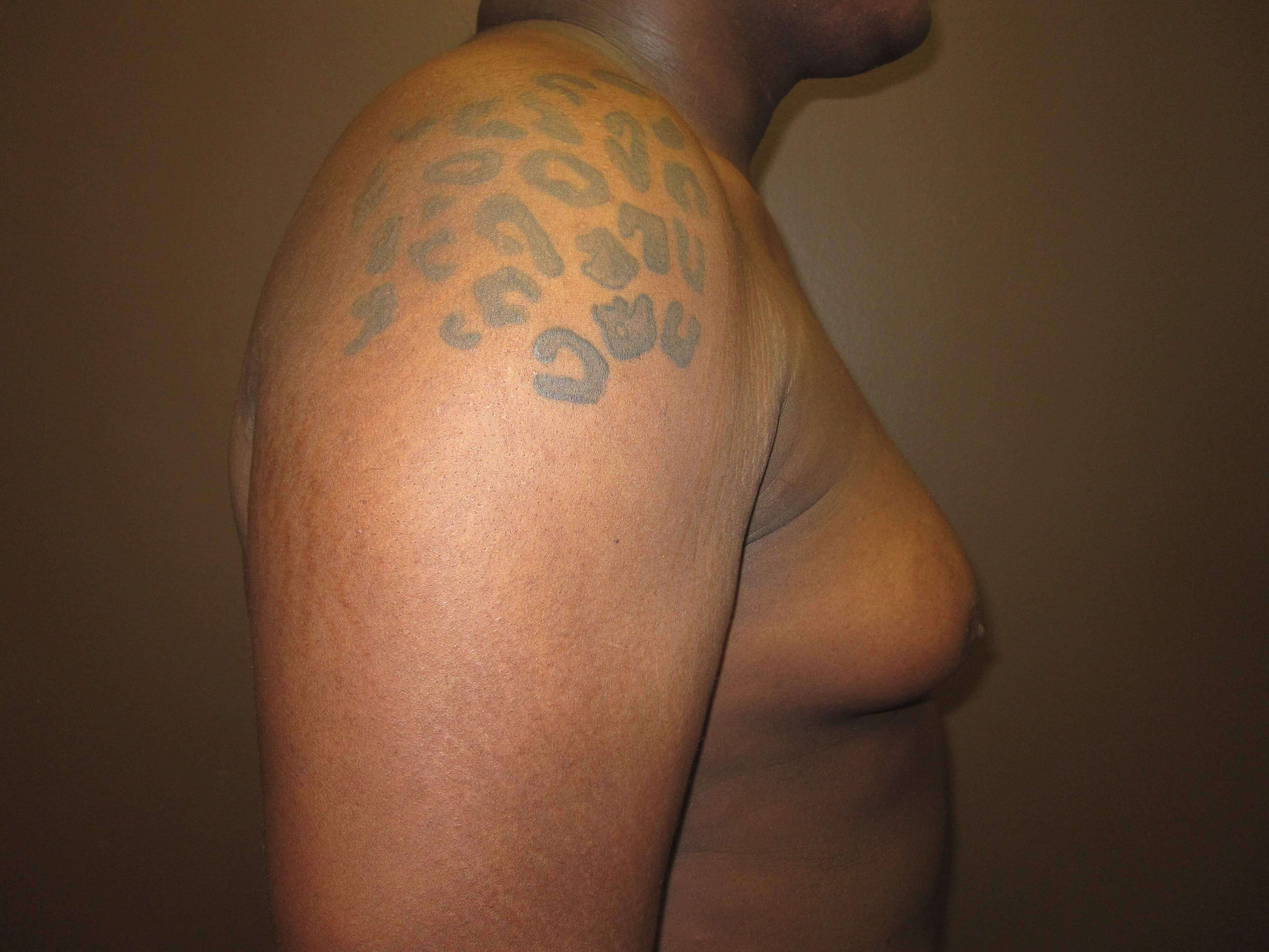 Gynecomastia (male breast redu Before