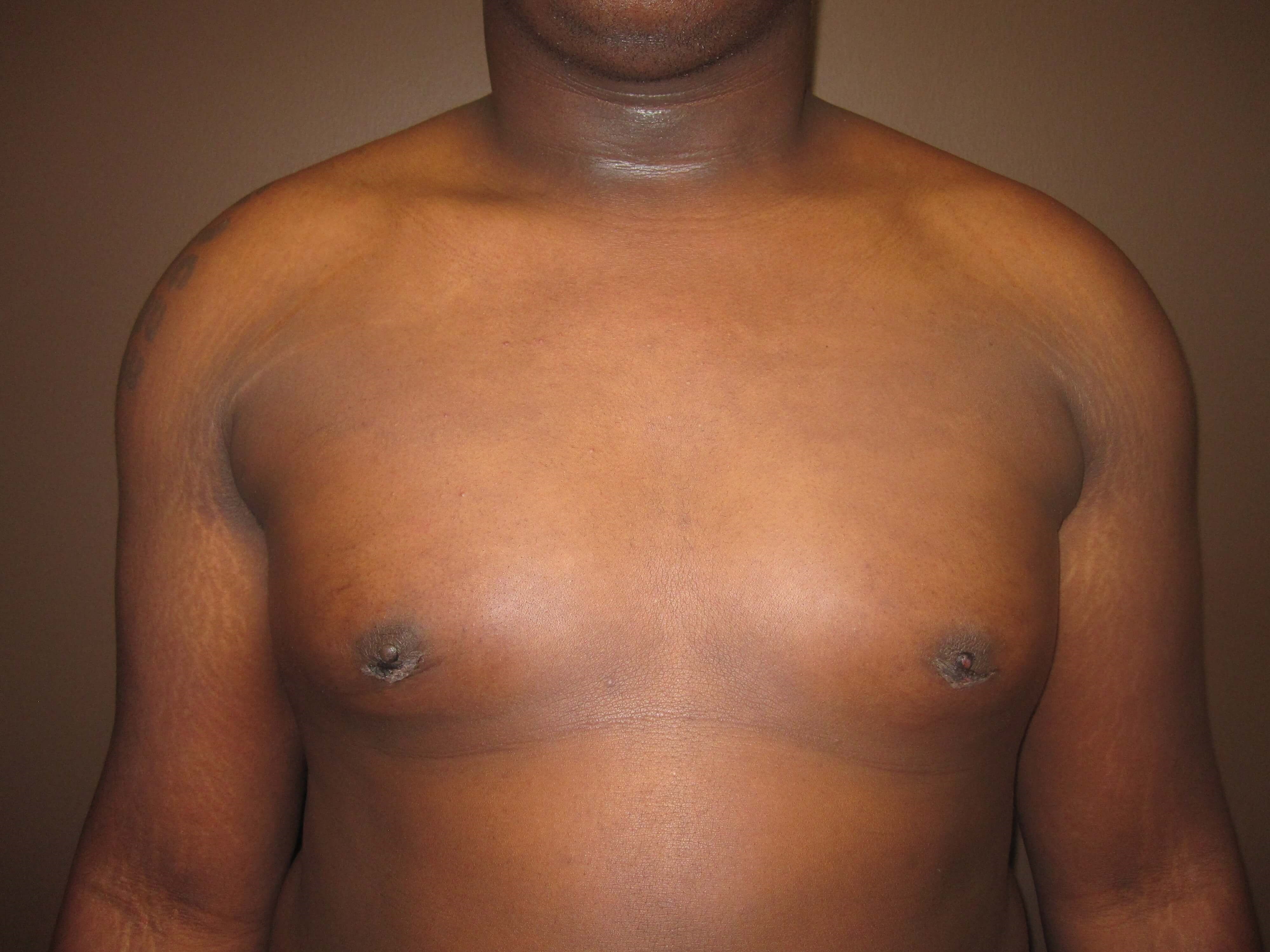 Gynecomastia (male breast redu After