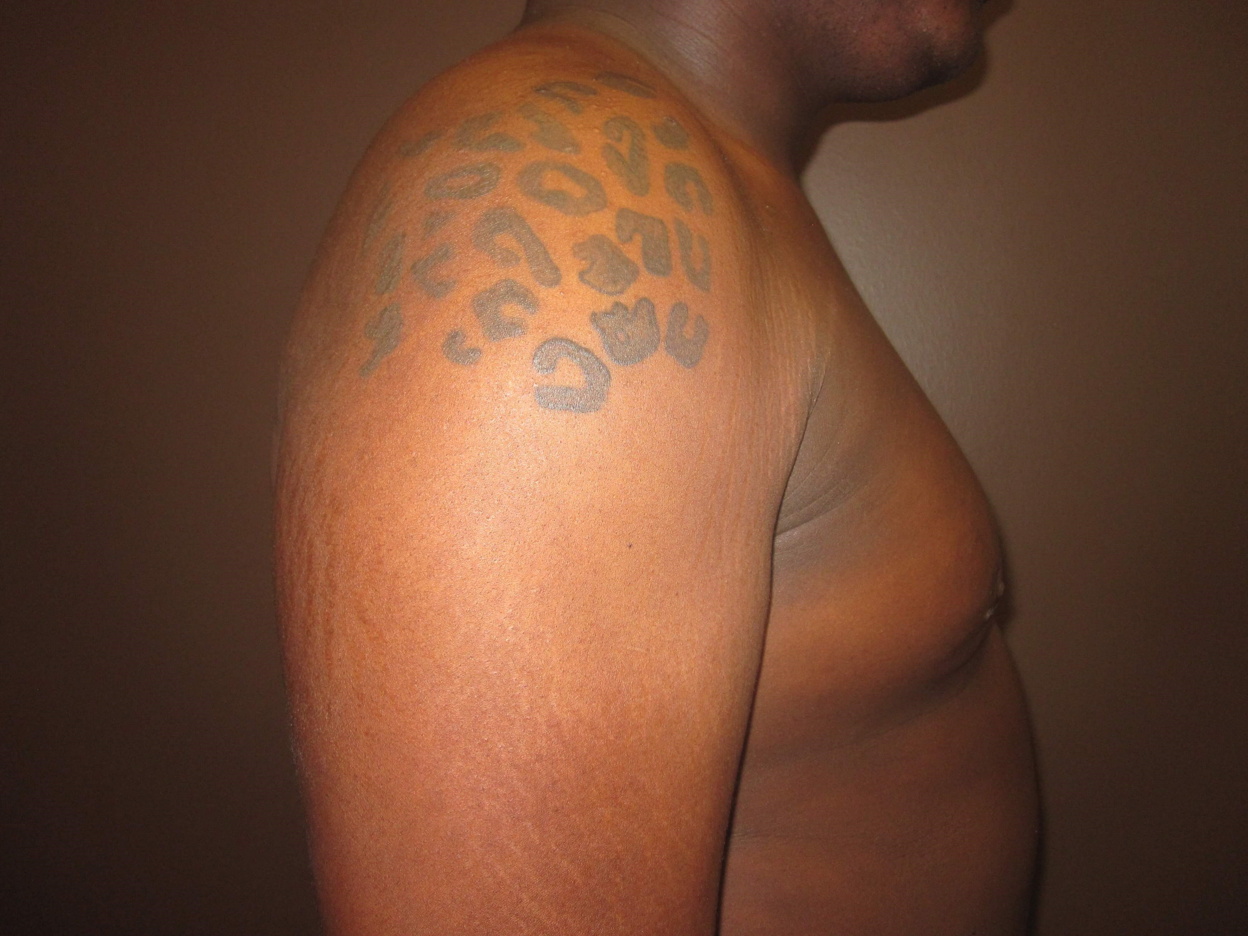 Gynecomastia (male breast redu After