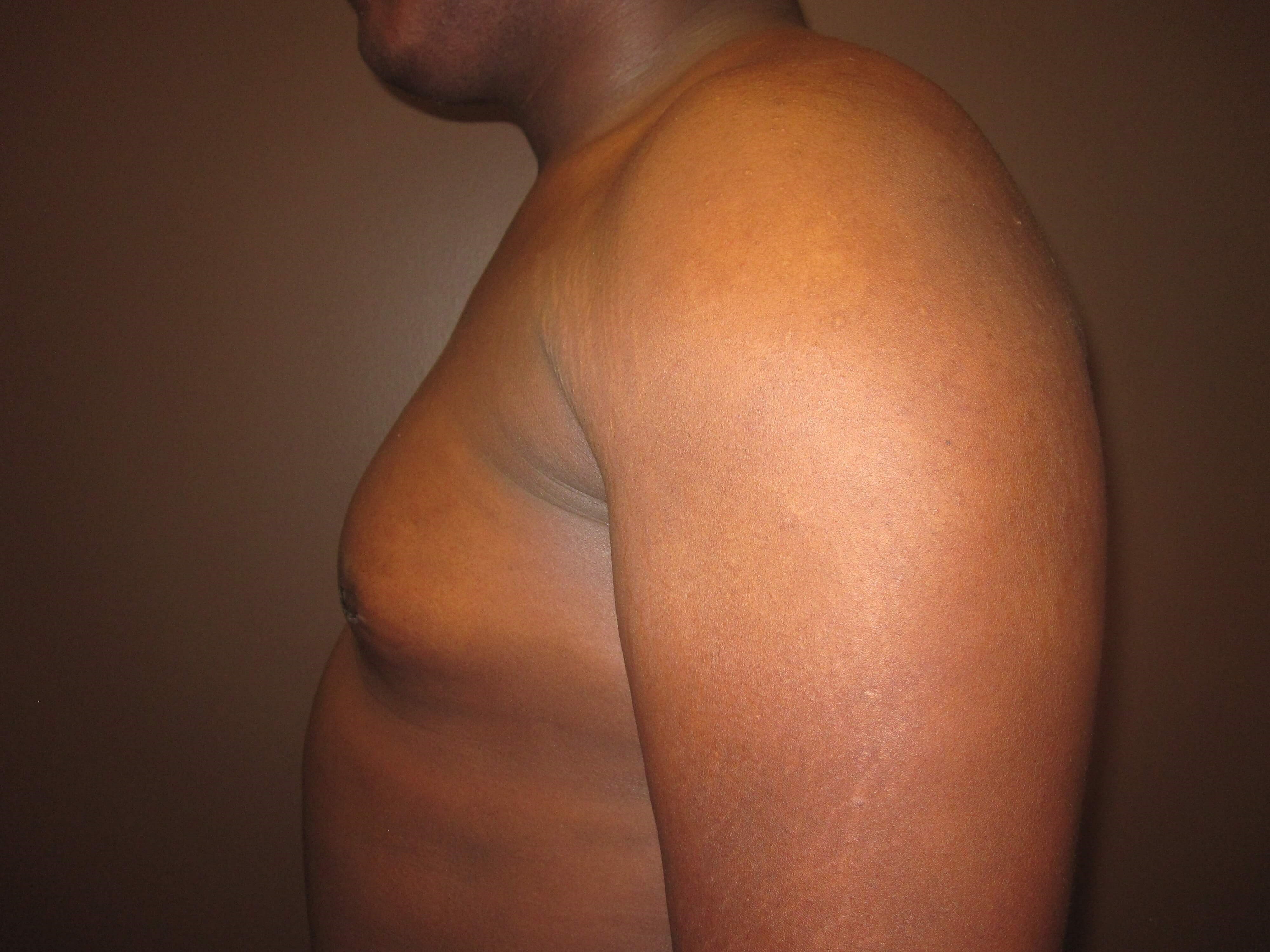 Gynecomastia (male breast redu After