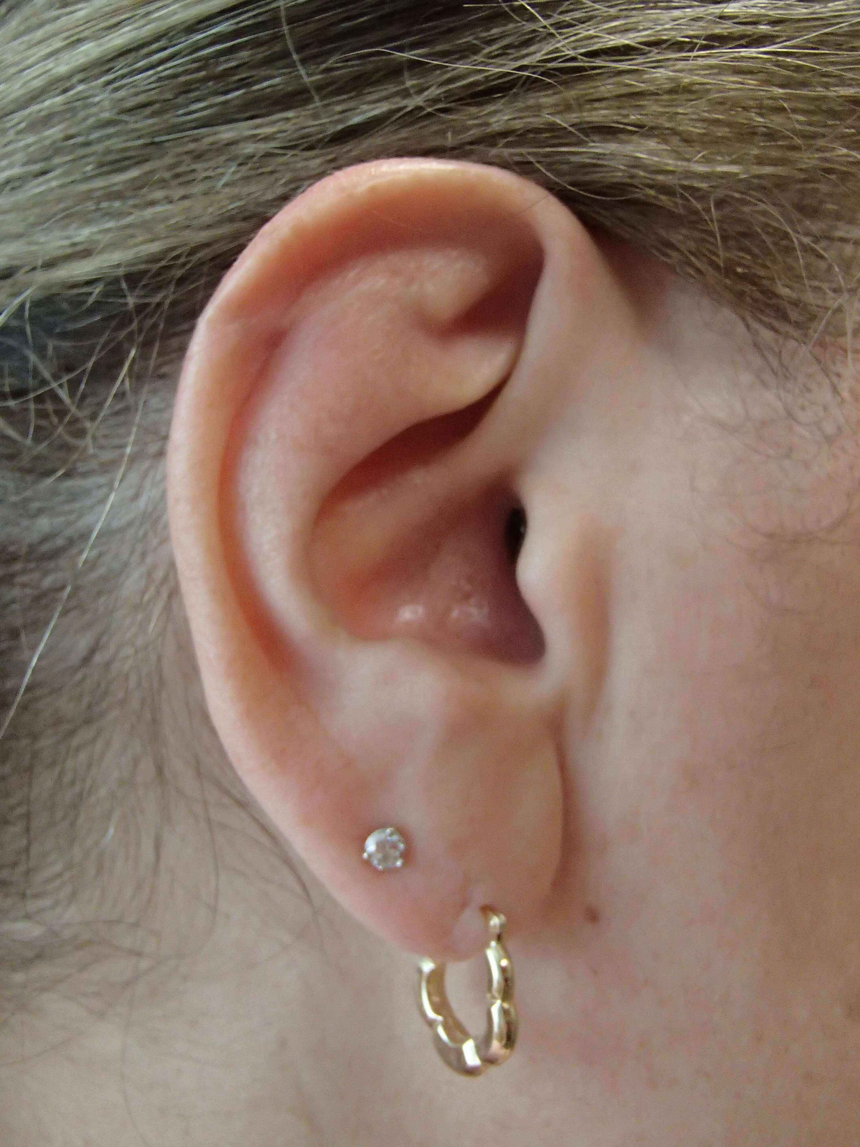 Otoplasty After